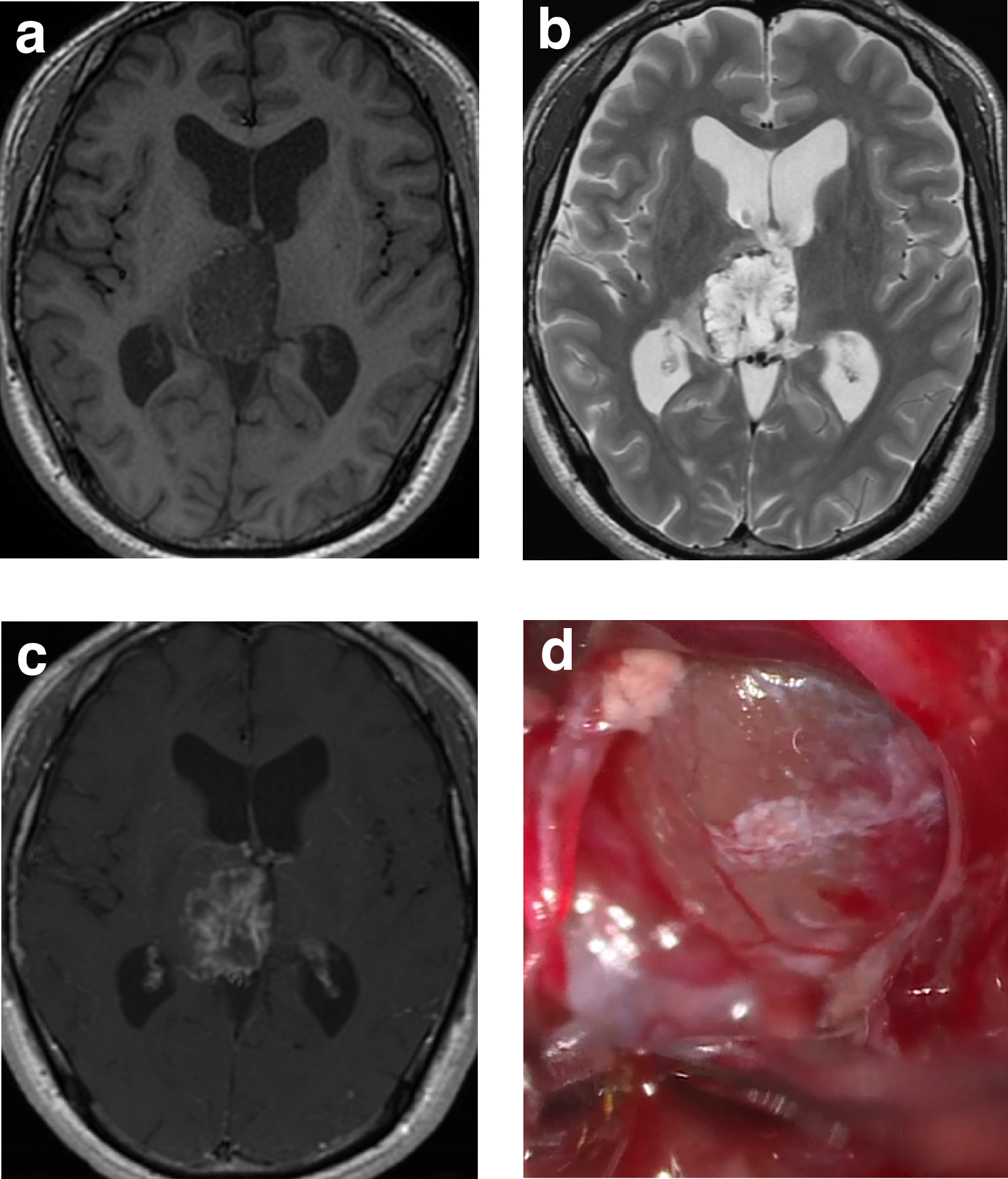Late-onset intracranial adenocarcinoma arising from a germ cell tumor 25 years after initial diagnosis