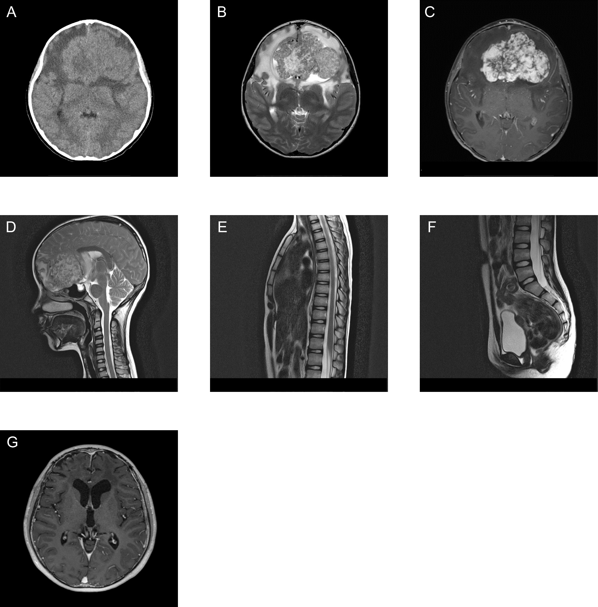 A rare case of supratentorial ependymosarcoma harboring :: fusion