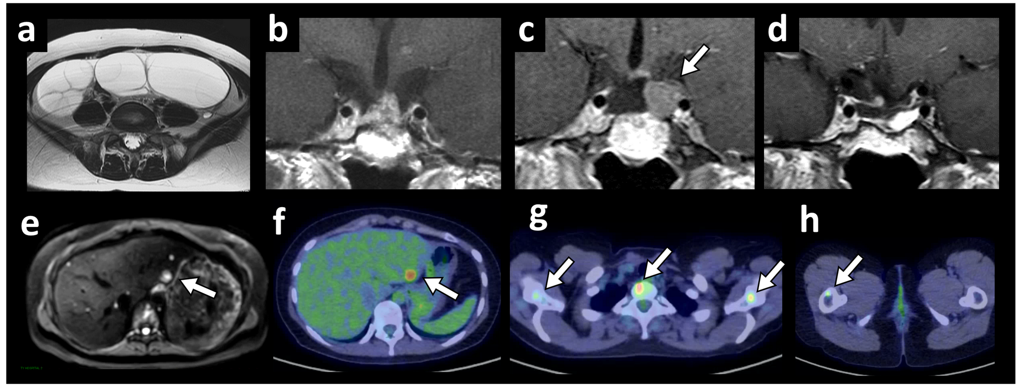 Histopathological evaluation of dopamine receptor D2 expression in symptomatic gonadotroph pituitary neuroendocrine tumors: a case series including a rare metastatic case responsive to a dopamine agonist