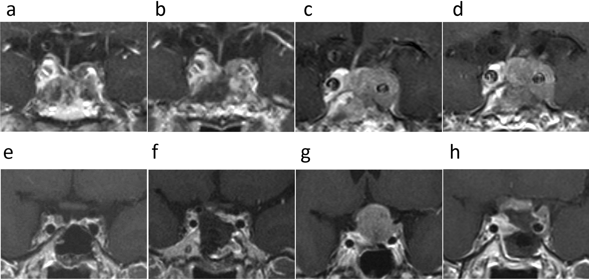 Emergence of NEC features in corticotroph PitNETs: primary tumor, radiation-induced transformation, or metastasis?
