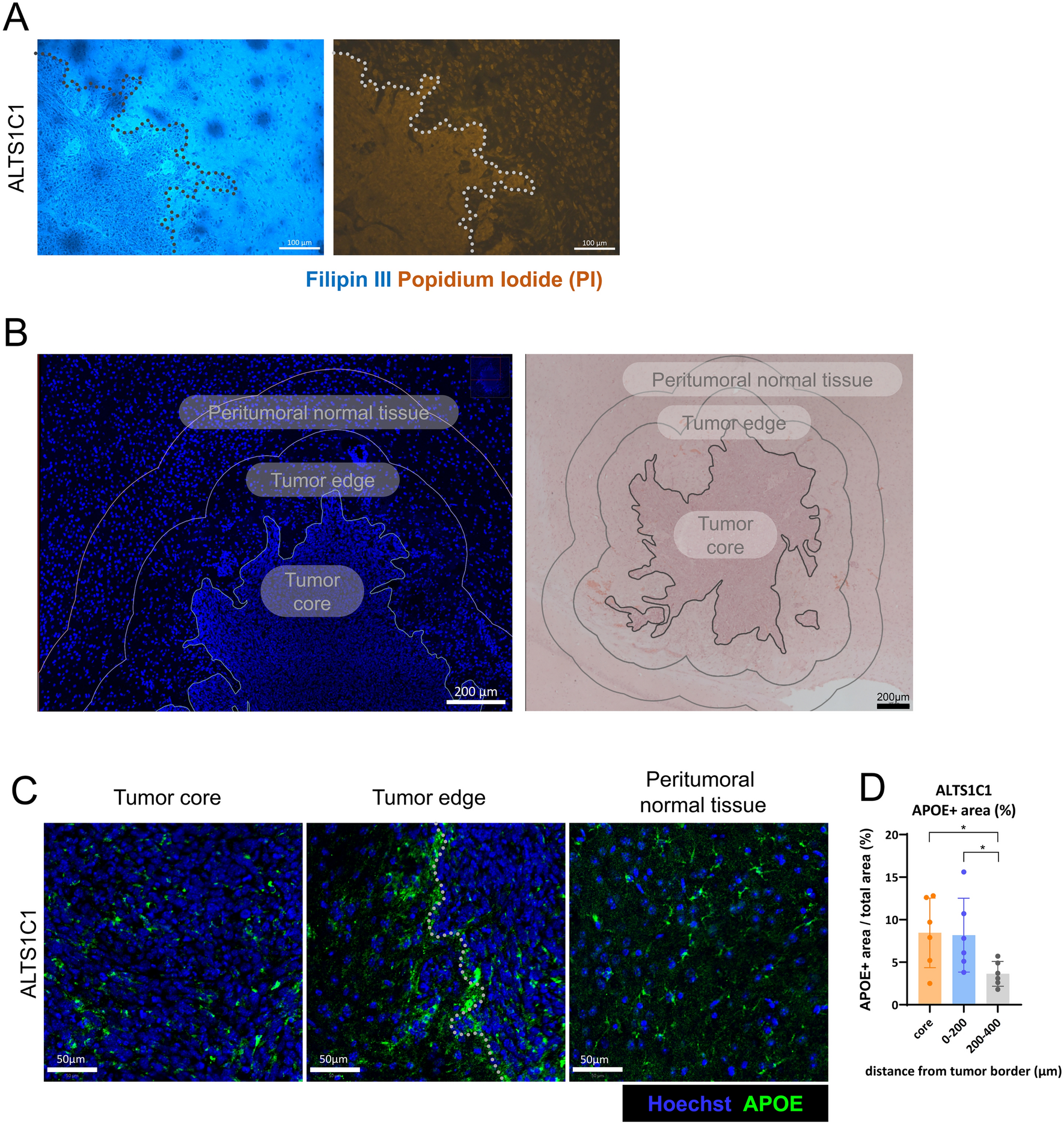 Activated astrocytes drive the accumulation of apolipoprotein E at the brain tumor edge