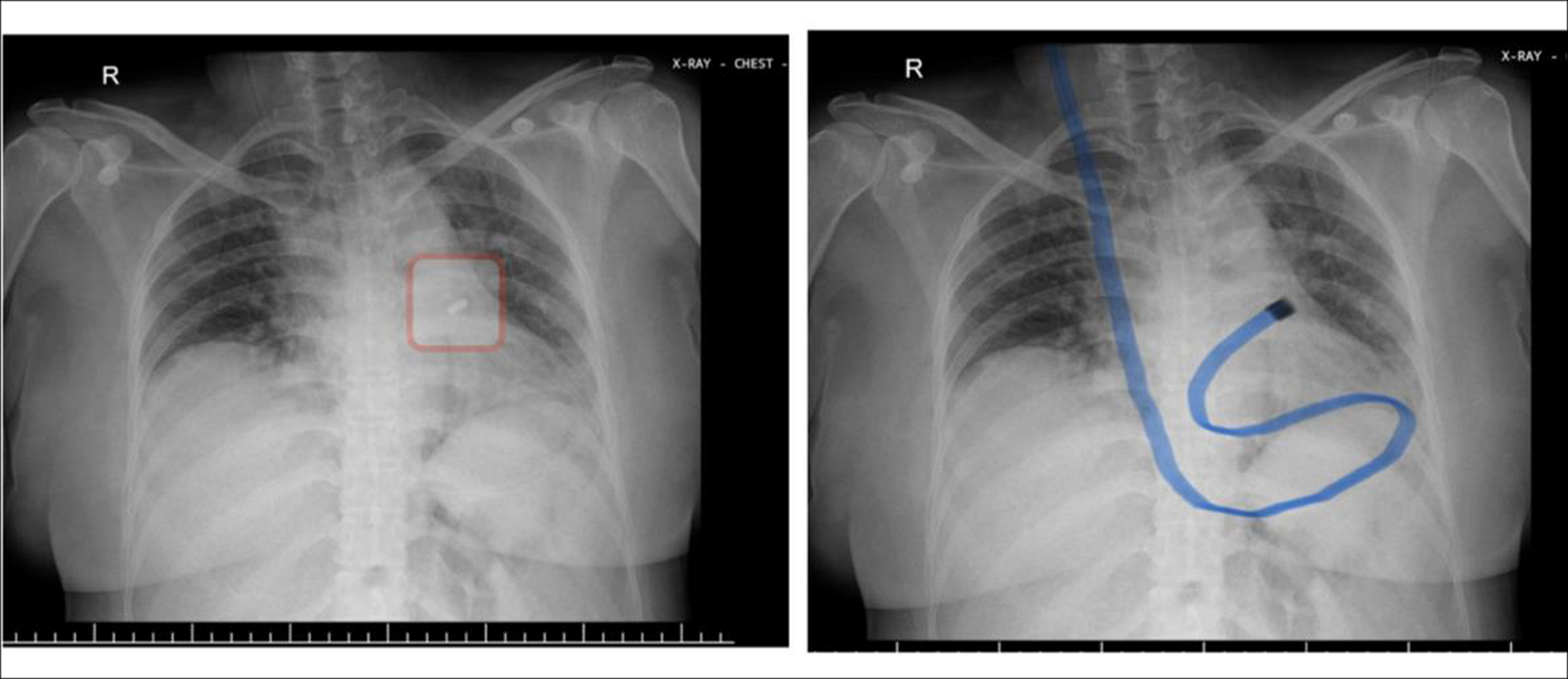 Case report: Ryle’s Tube Insertion into Pericardium Perforating the Internal Jugular and Right Atrium