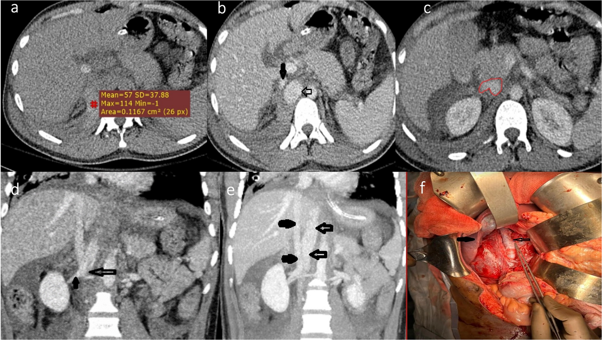 Isolated IVC Injury: A Rare Trauma Surprise