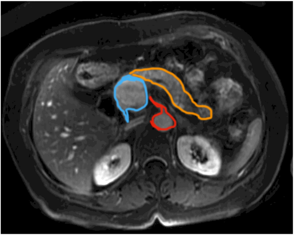 Minimally Invasive Management of a Bulky Retropancreatic Portal Vein Aneurysm: Laparoscopic Central Pancreatectomy and Intracorporeal Venous Patch Reconstruction – A Video Report