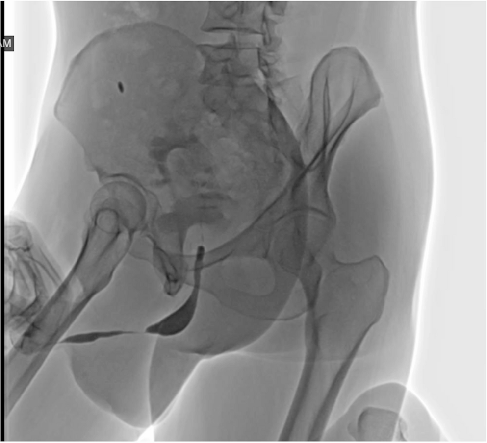 Urethral Plasmacytoma Masquerading as Urethral Stricture: a Rare Case and Review of Literature