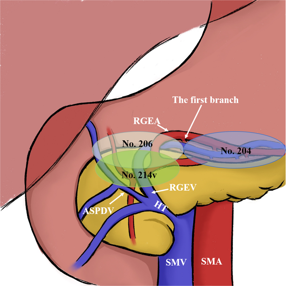 Lymph Node Metastasis and Risk Factors in the Gastrocolic Ligament of Patients with Hepatic Flexure Colon Cancer