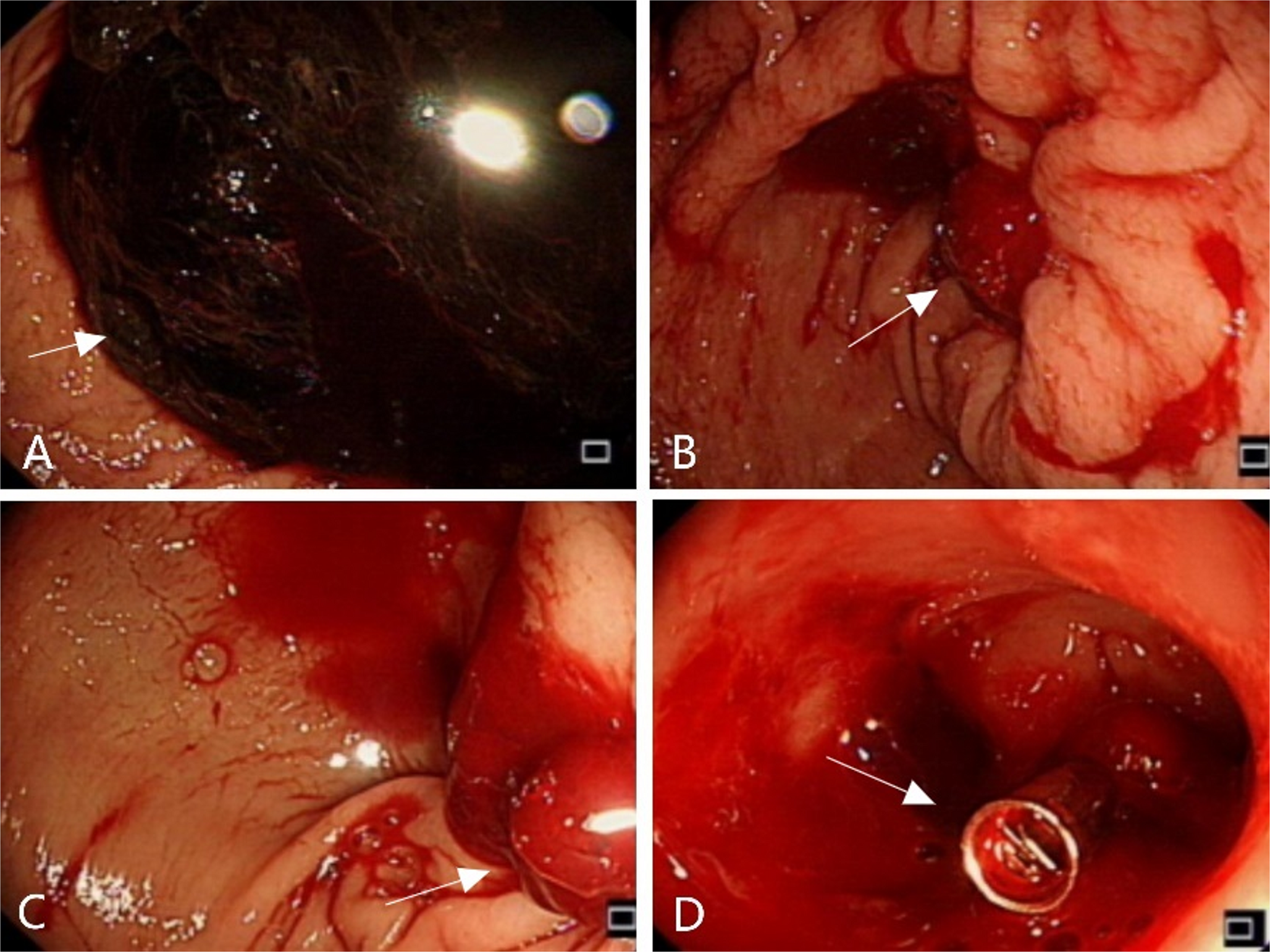Liquid Embolization with Iodized Oil and Tissue Glue for Ruptured Gastroduodenal Artery Pseudoaneurysm Presenting as Peptic Ulcer Hemorrhage: A Case Report
