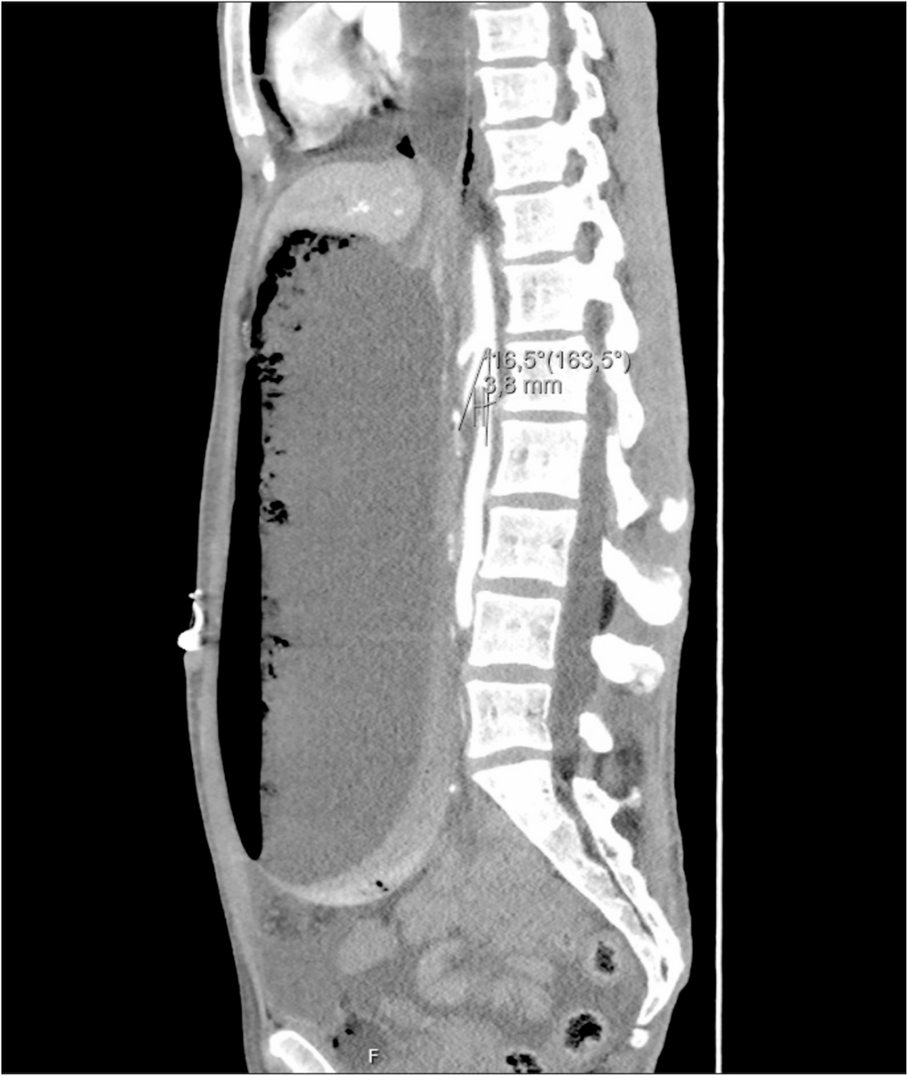Gastric Ischemia Due to Superior Mesenteric Artery Syndrome in Anorexia Nervosa: A Case Report