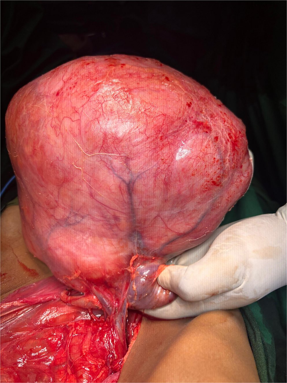 Renal Mixed and Epithelial Stromal Tumour in a 9-Year-Old-A Rare Neoplasm