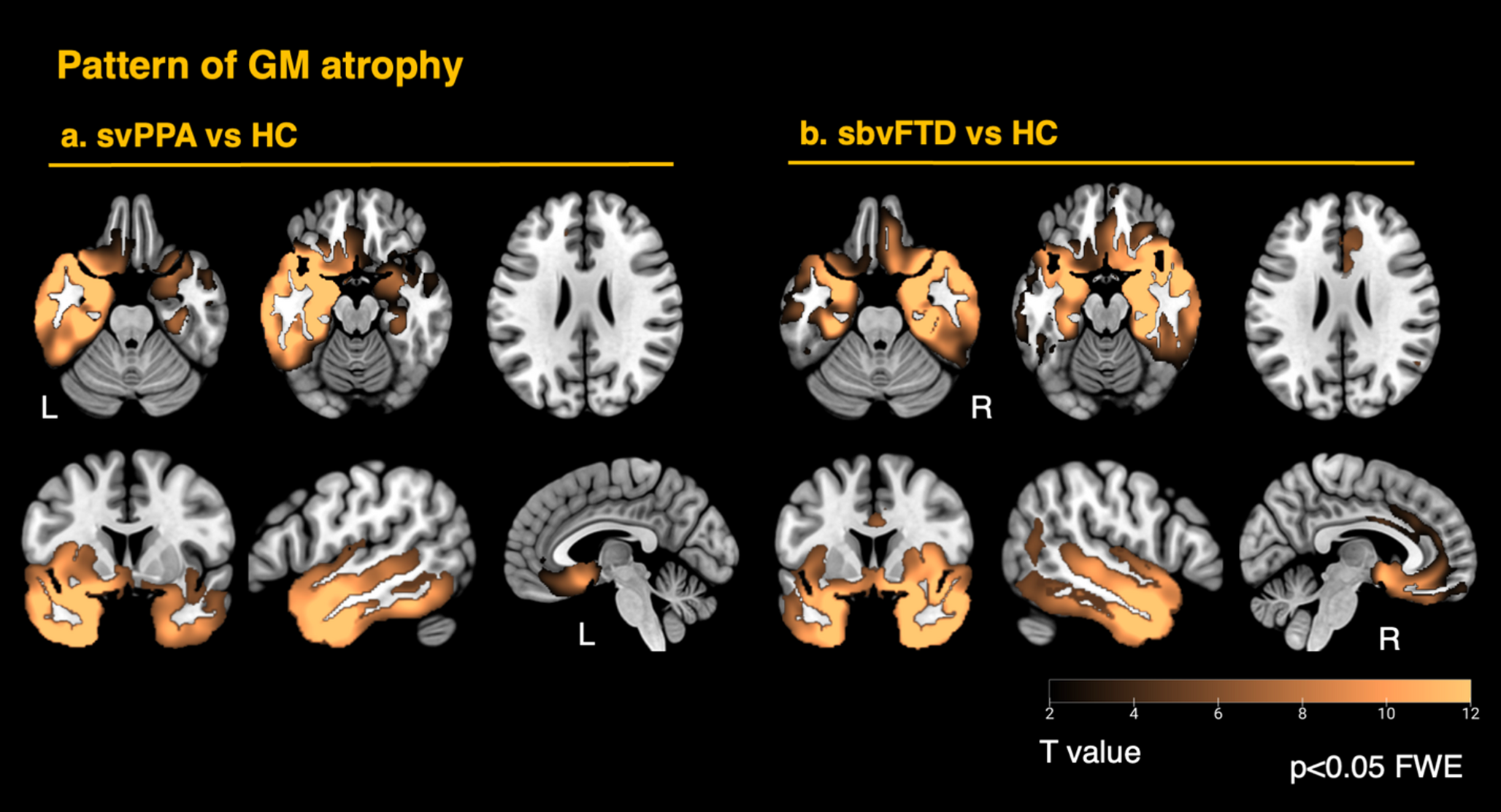 Fixel-based analysis reveals detailed white matter changes in semantic dementia