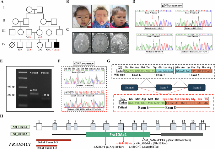 A novel homozygous splicing variant in FRA10AC1: further delineation of the phenotype