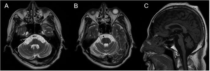 A case report of spinocerebellar ataxia with TRPC3 gene mutation and review of literature