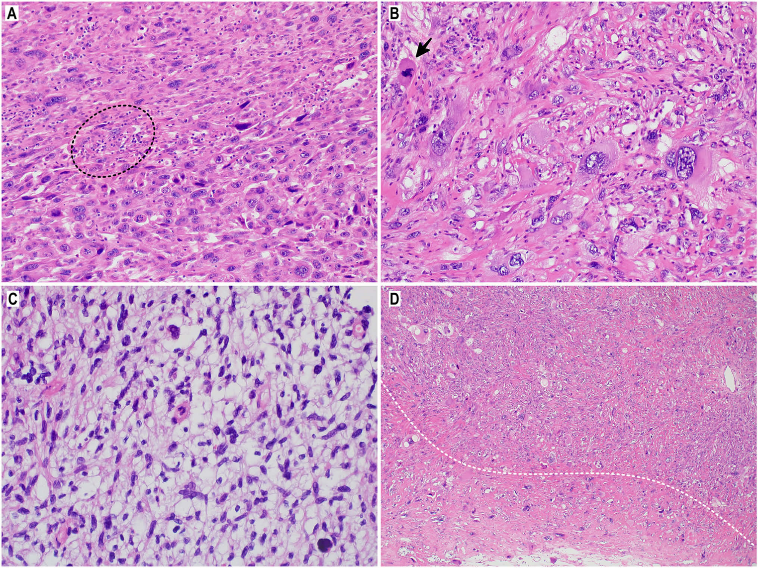 Clinicopathological and genomic profiling in undifferentiated pleomorphic sarcoma: Small series, clear message