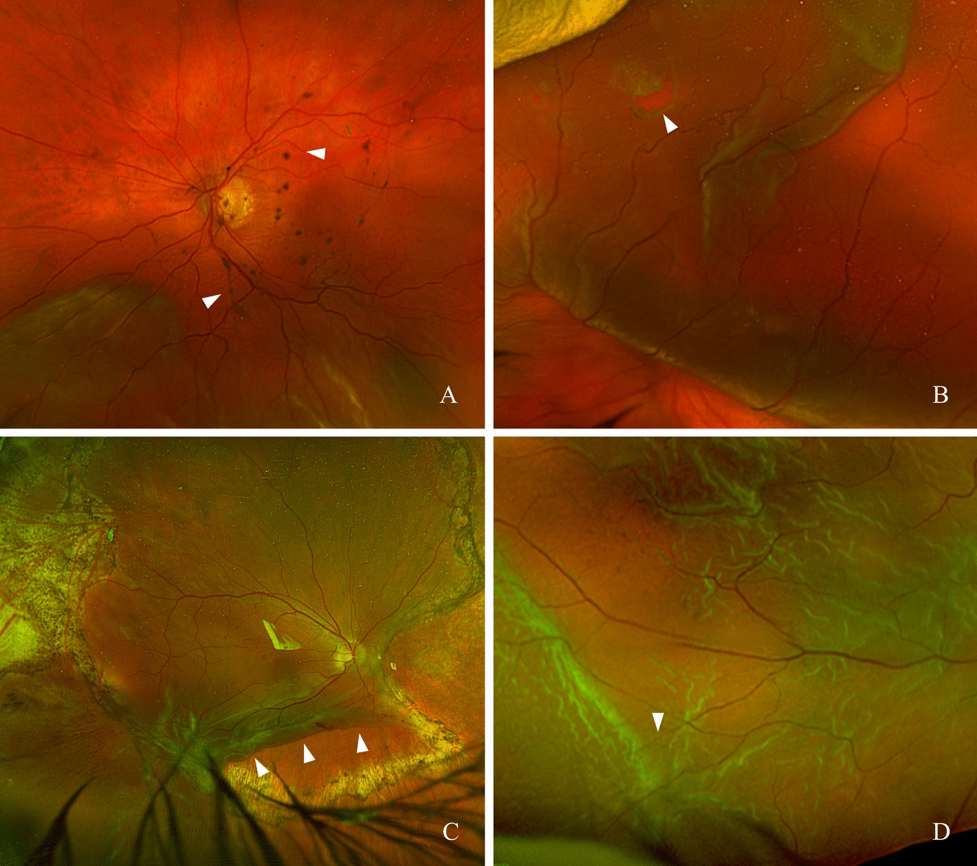 Drug strategies for the treatment and prevention of proliferative vitreoretinopathy: an overview of innovative treatment concepts