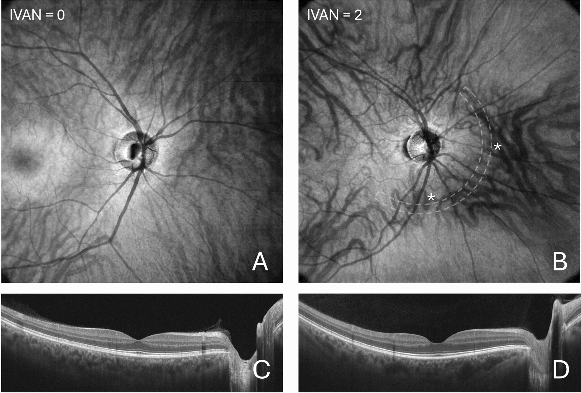 Peripapillary intervortex venous anastomoses in central serous chorioretinopathy