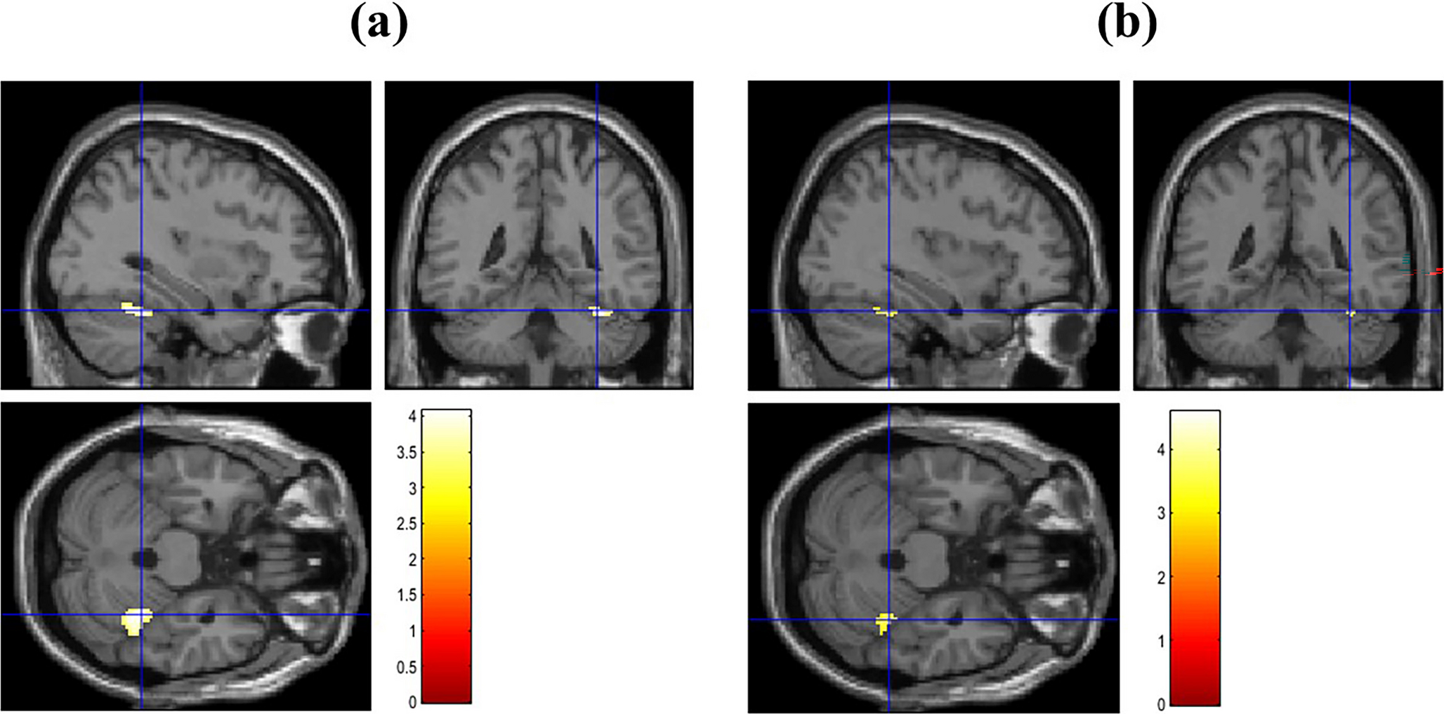 Association between blue fish intake frequency and glucose metabolism in the right cerebellum