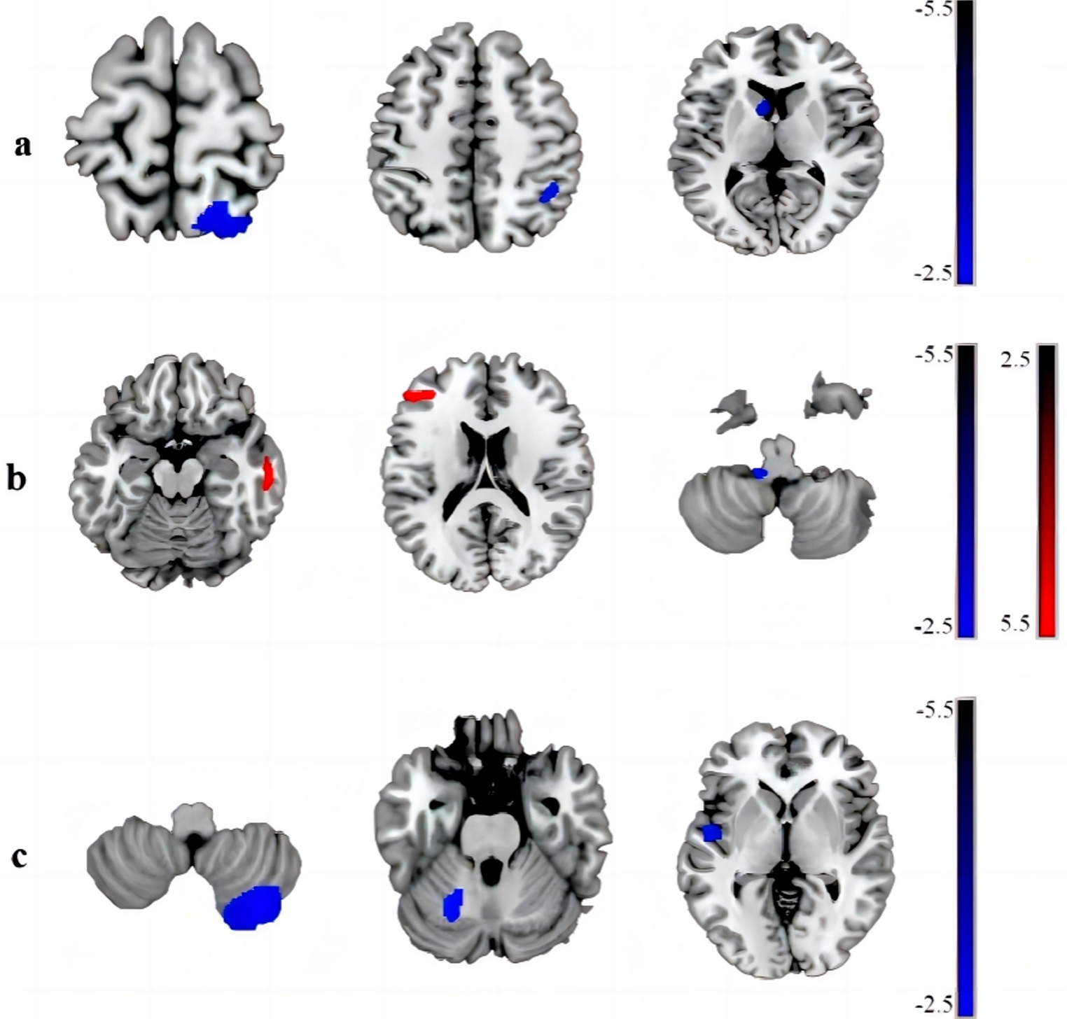 Analysis of parkinson’s disease patients with Gastrointestinal symptoms using structural and functional magnetic resonance imaging