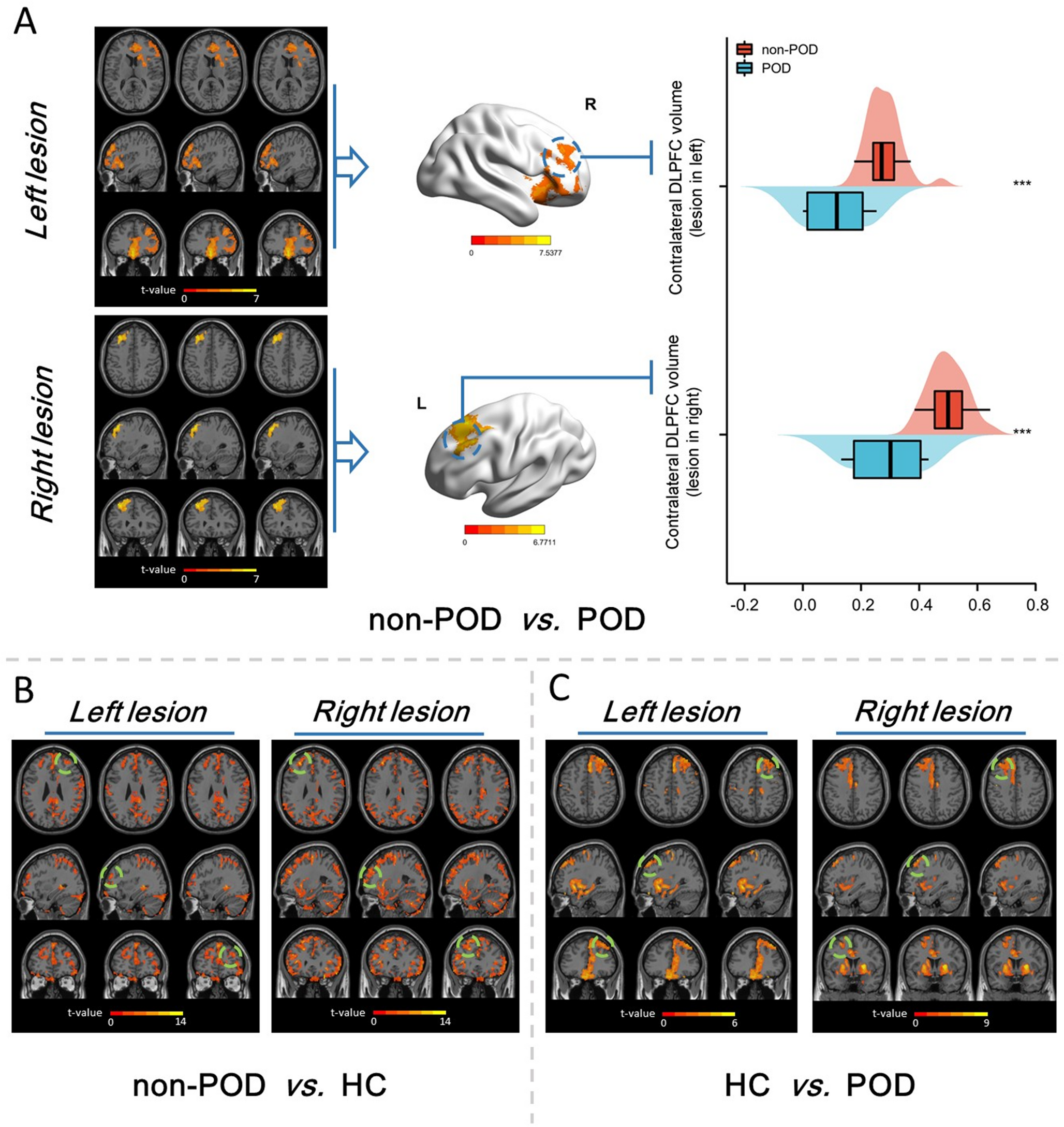 Evidence for cognitive compensation mechanism in the postoperative delirium: a prospective multi-modal neuroimaging cohort study