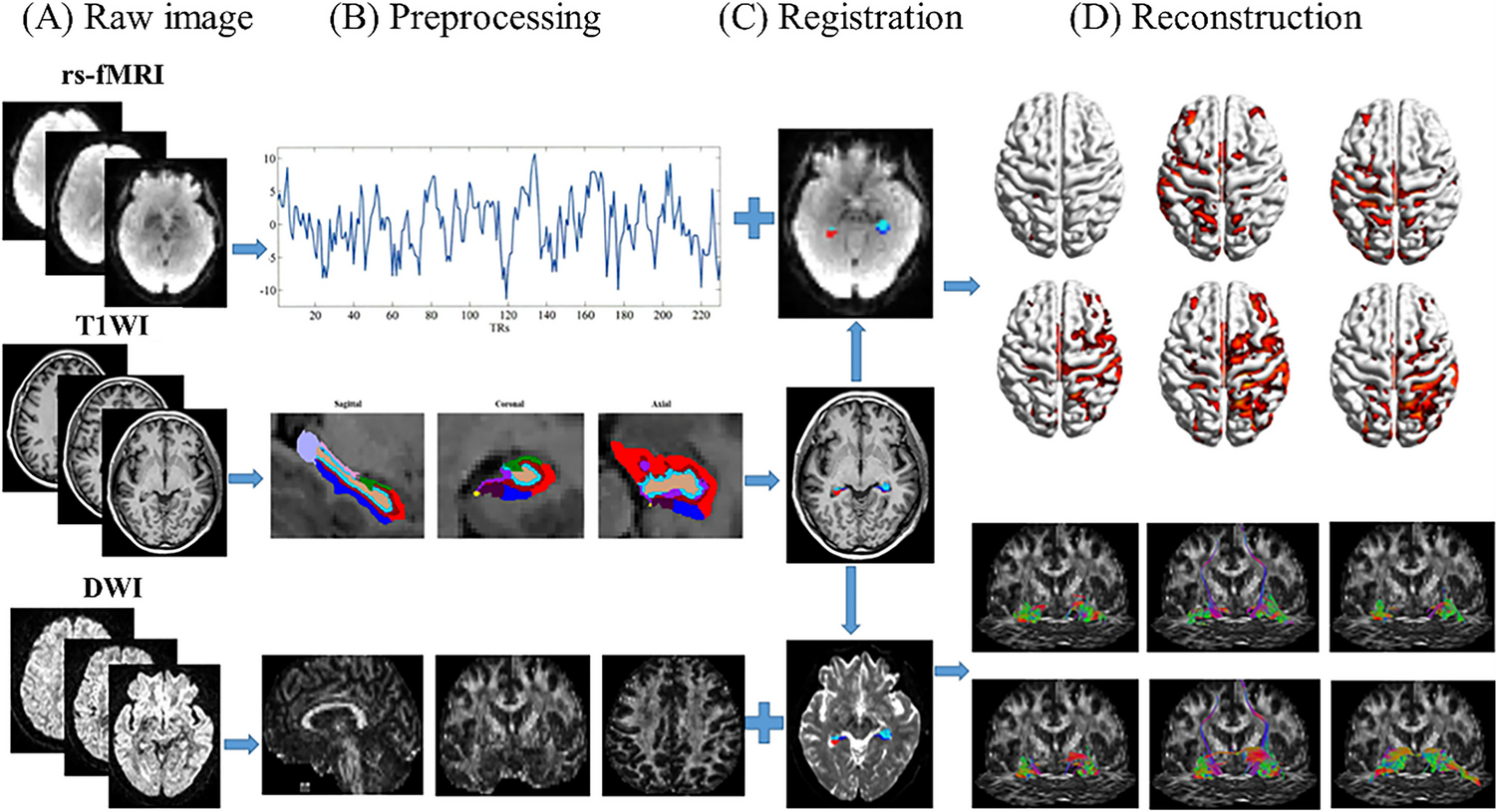 Hippocampal subfield-specific alterations in post-stroke dementia with subcortical lesion