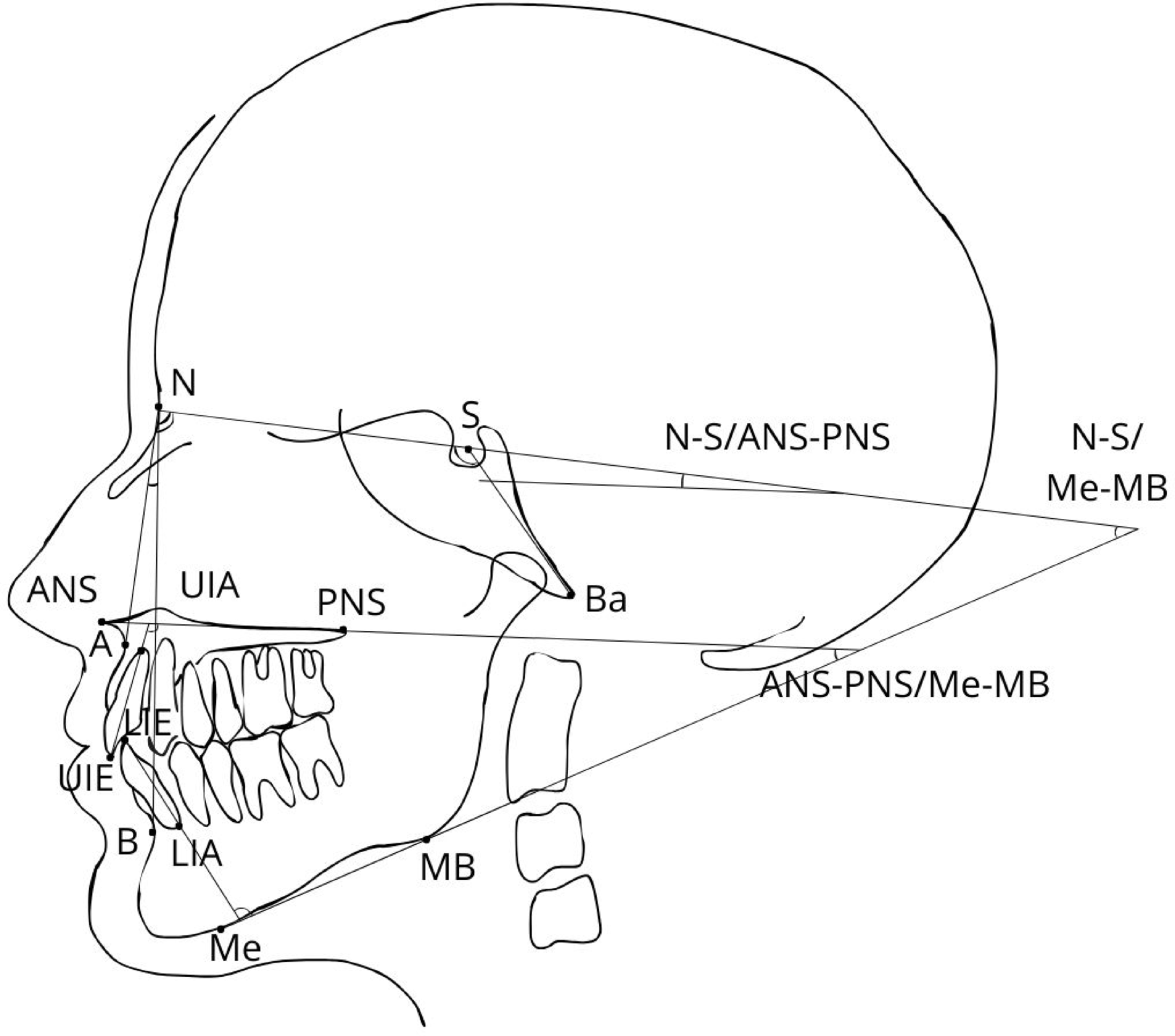 In Individuals with Osteogenesis Imperfecta, Cephalometric Findings Suggest that Bisphosphonate Therapy May Improve Craniofacial Growth