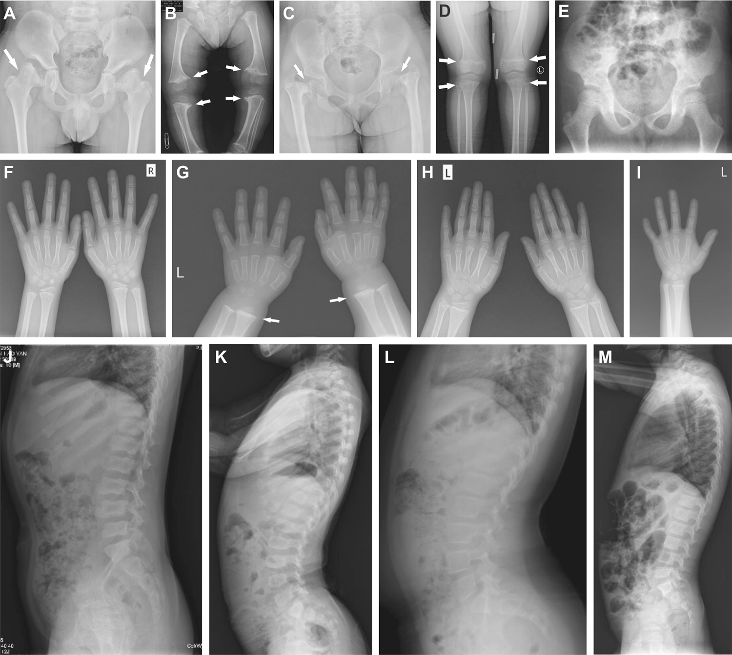 Clinical, Molecular Characteristics, and Genotype–Phenotype Relationships of Metaphyseal Chondrodysplasia Type Schmid