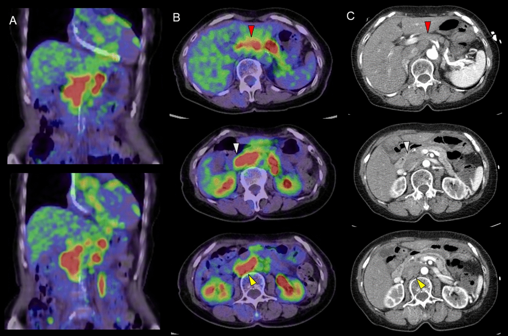 FDG uptake in upper abdominal lymph node as a distinctive pattern in sarcoidosis