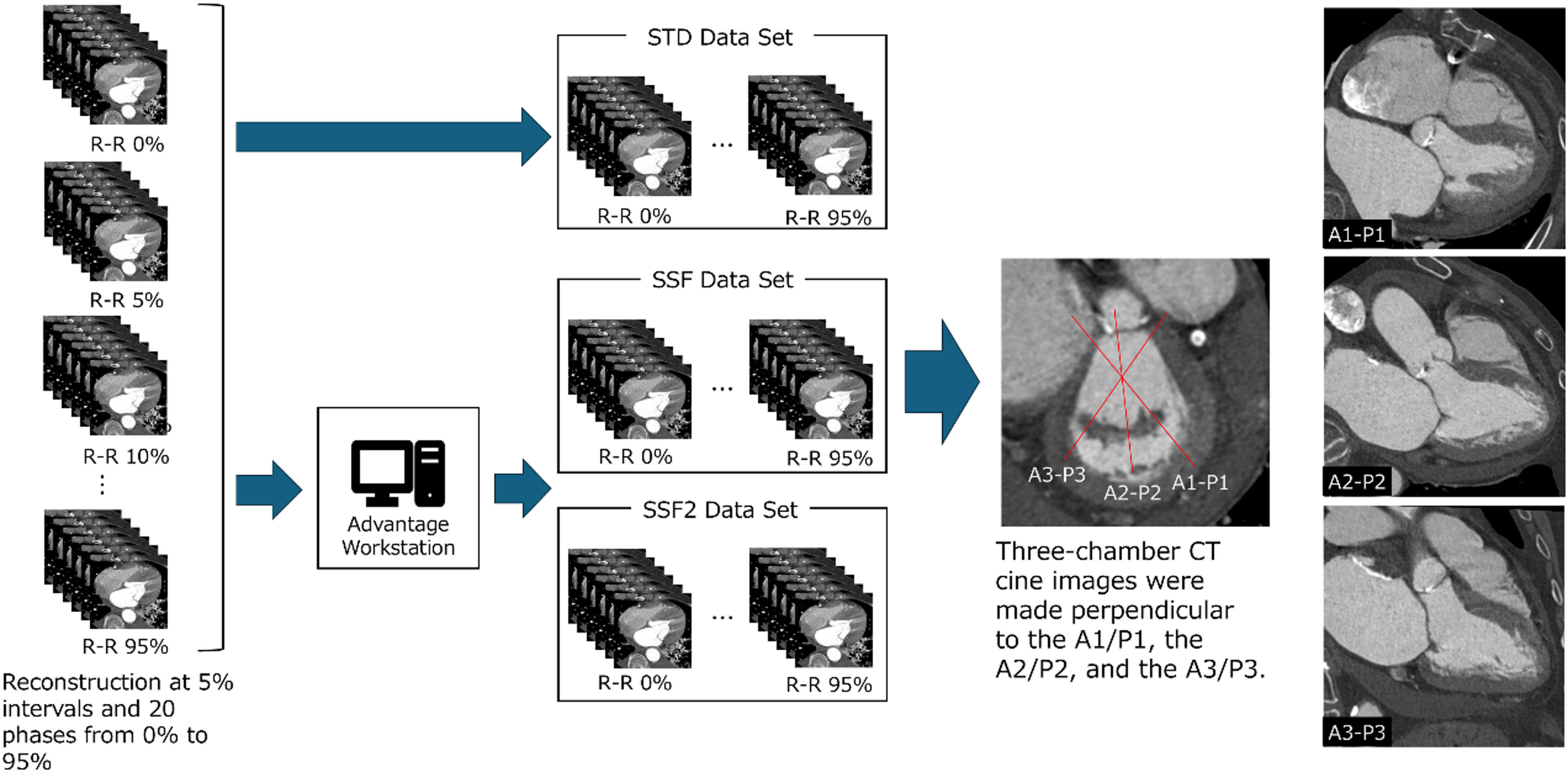 SnapShot Freeze 2.0, a second-generation motion-correction algorithm, improves mitral valve image quality in preoperative cardiac computed tomography for mitral regurgitation