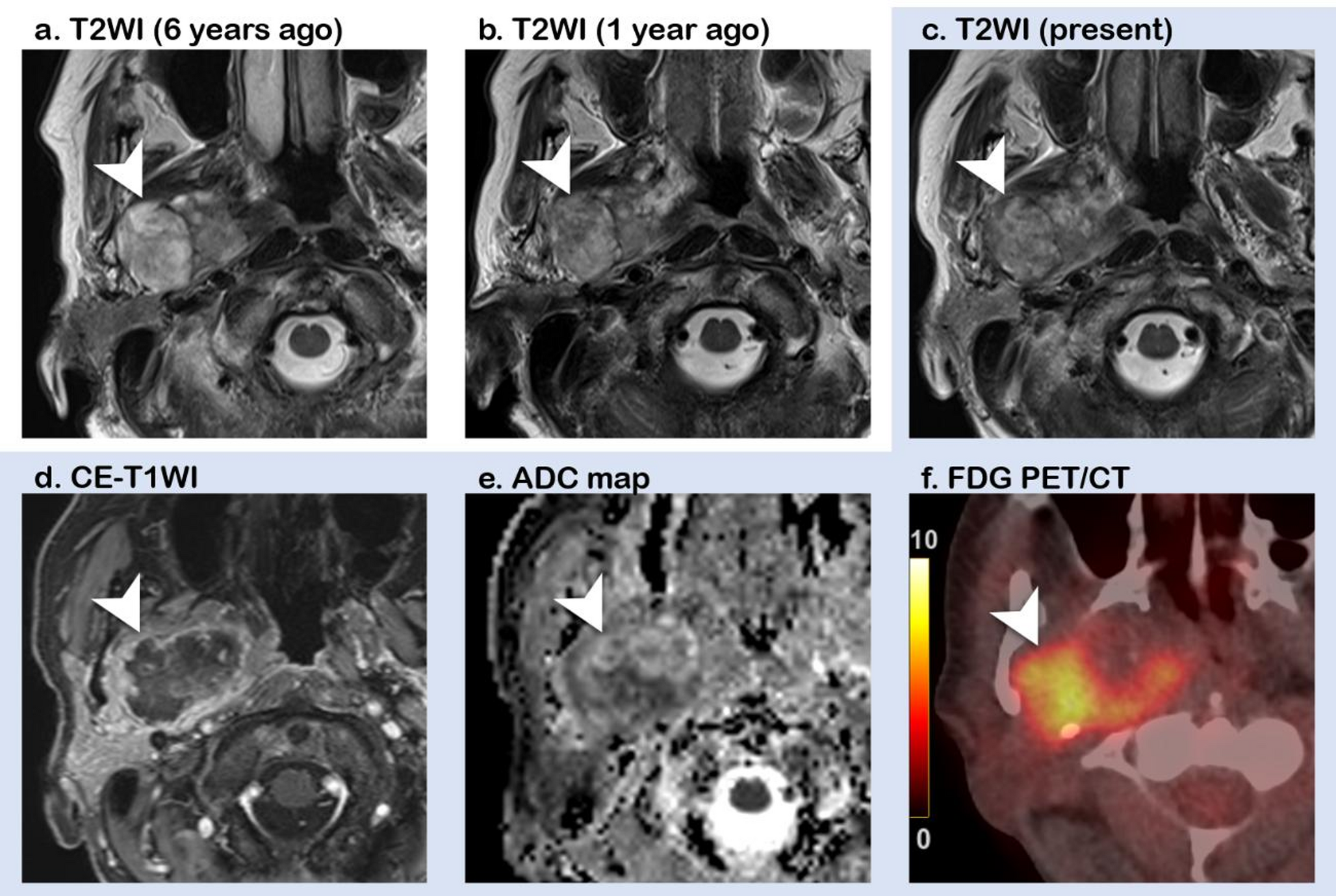 Paradoxical regression: hidden aggression in carcinoma ex pleomorphic adenoma