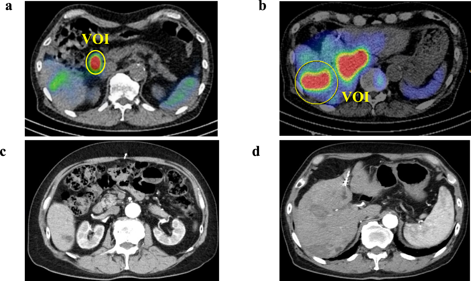 Quantitative indices from post-PRRT SPECT/CT: an exploratory approach to early imaging biomarkers in neuroendocrine tumors