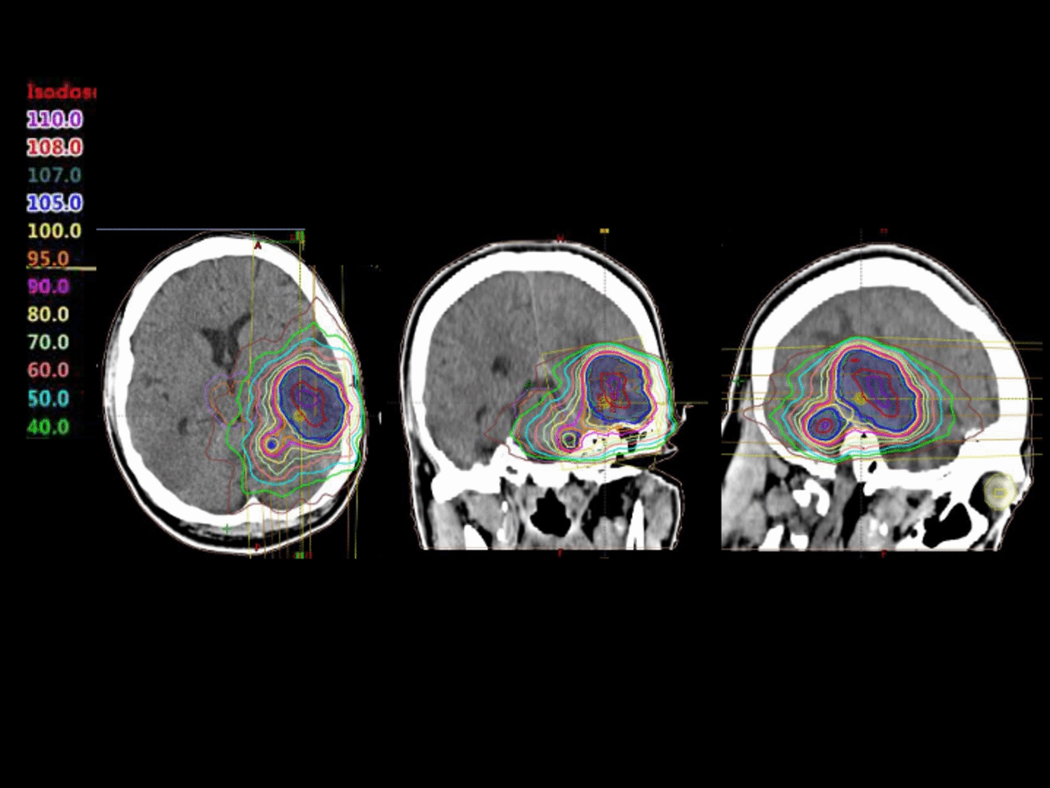 Safety and efficacy of salvage reirradiation for recurrent high-grade gliomas: a retrospective analysis