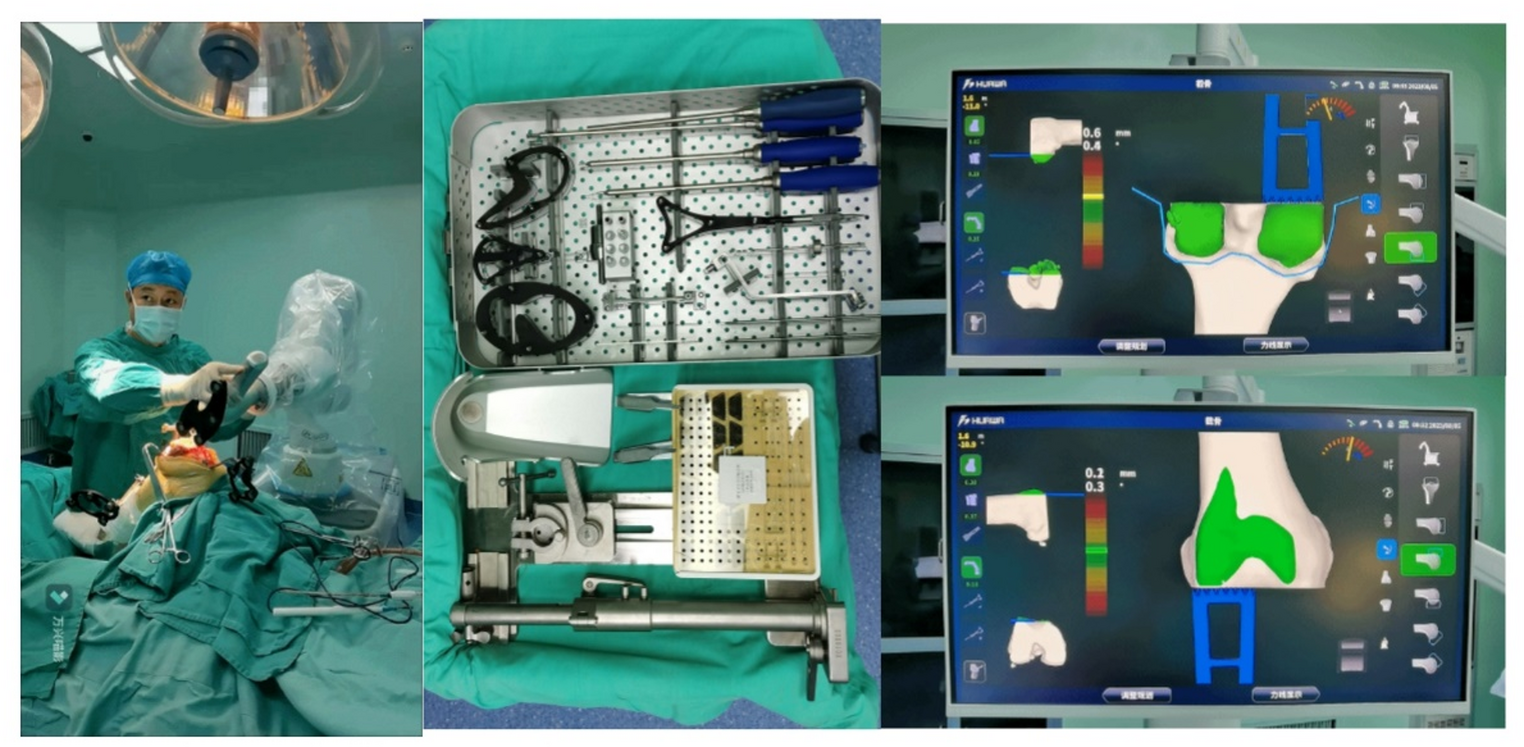Efficacy study of robot-assisted total knee arthroplasty in patients with different levels of medical experience