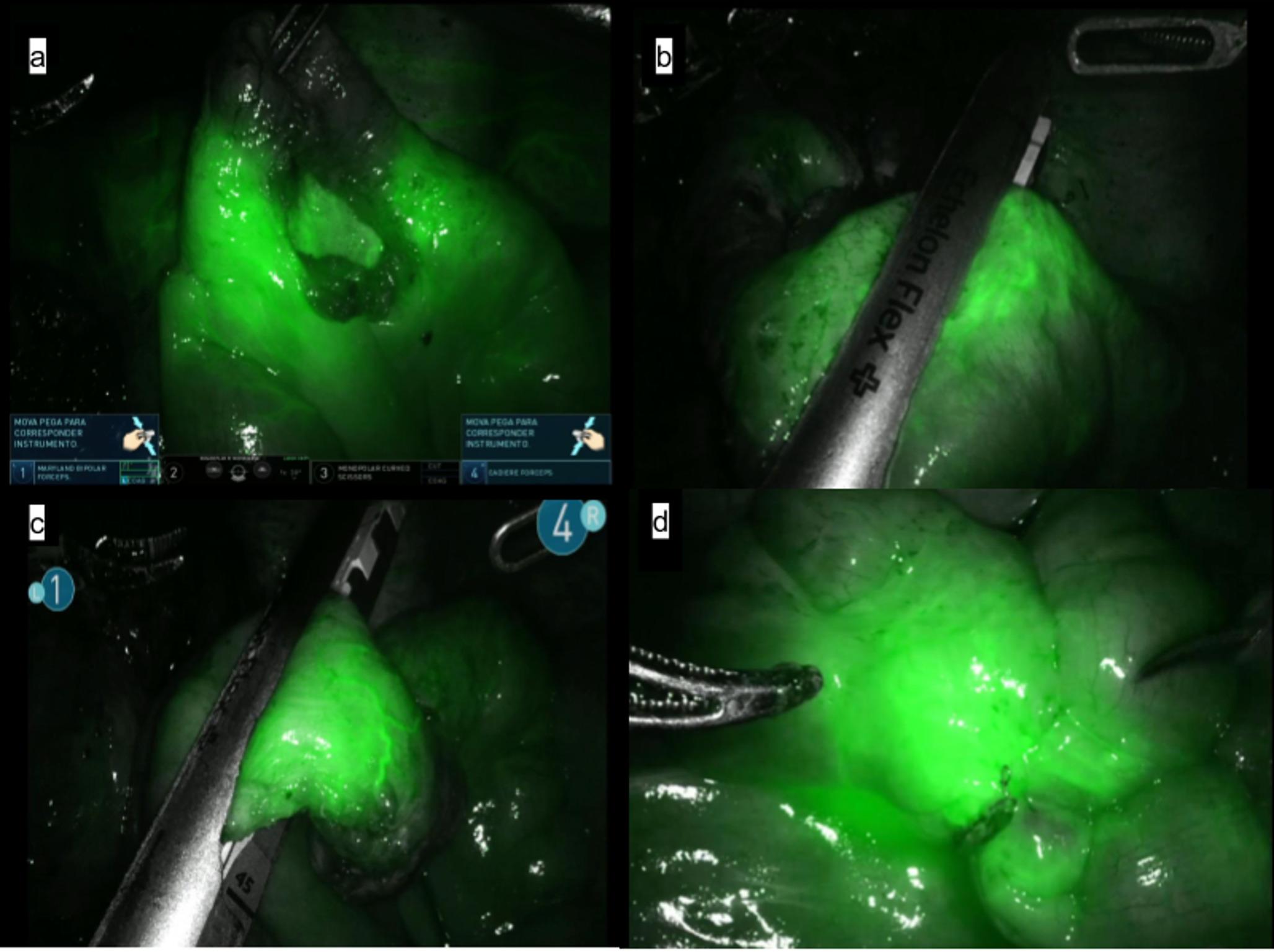 Indocyanine green in intestinal endometriosis surgery: a multicenter evaluation of anastomotic safety