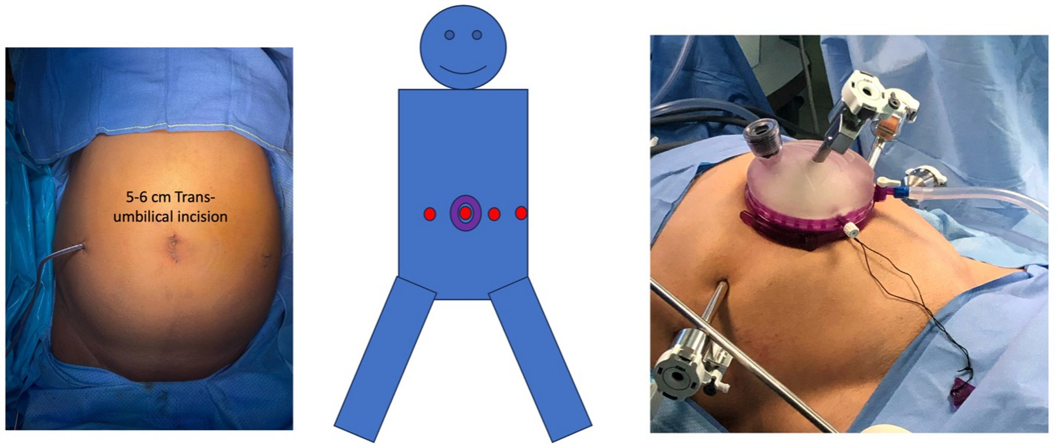 The road to 100: single center experience with the first 100 consecutive robotic kidney transplants
