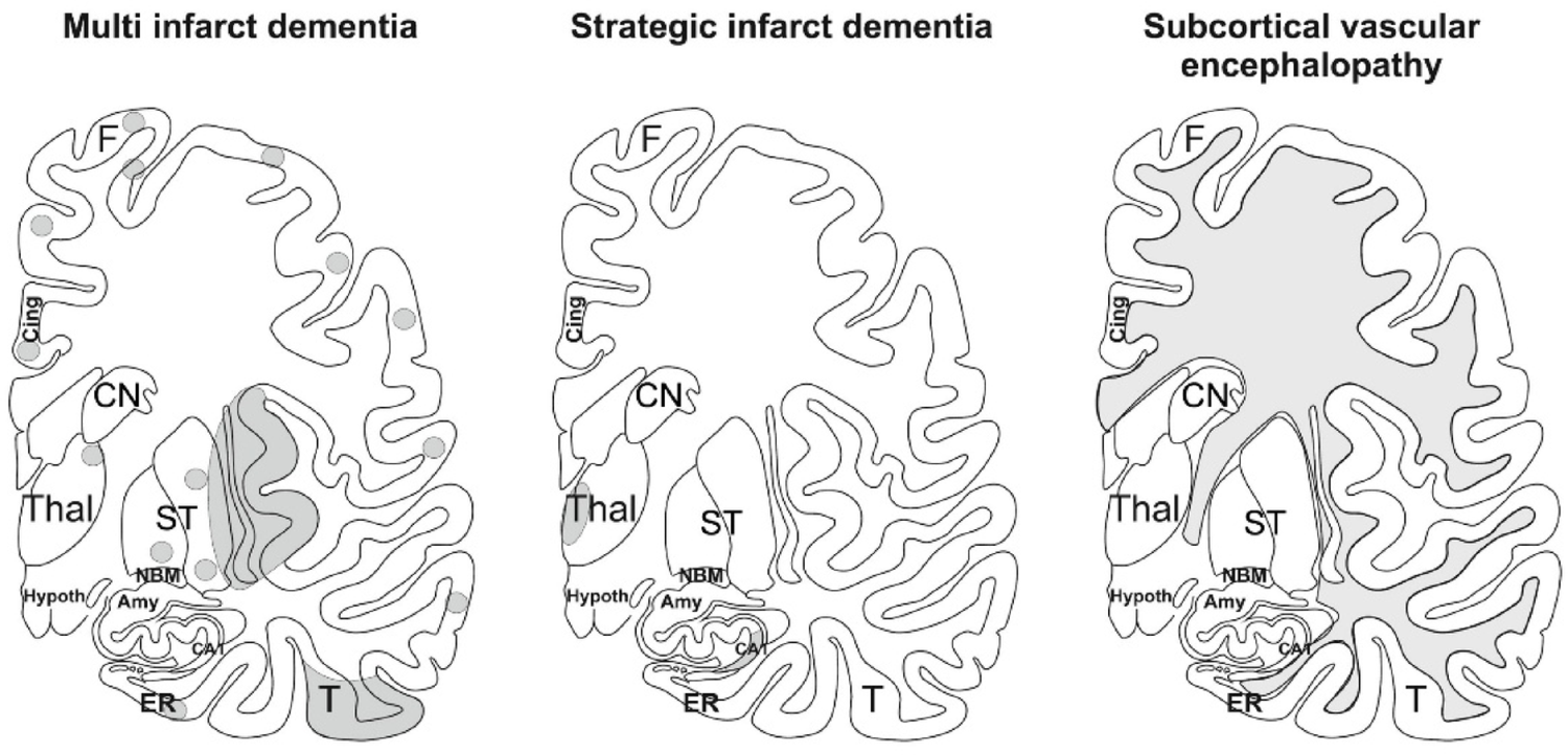 The enigma of vascular dementia: current state and emerging perspectives