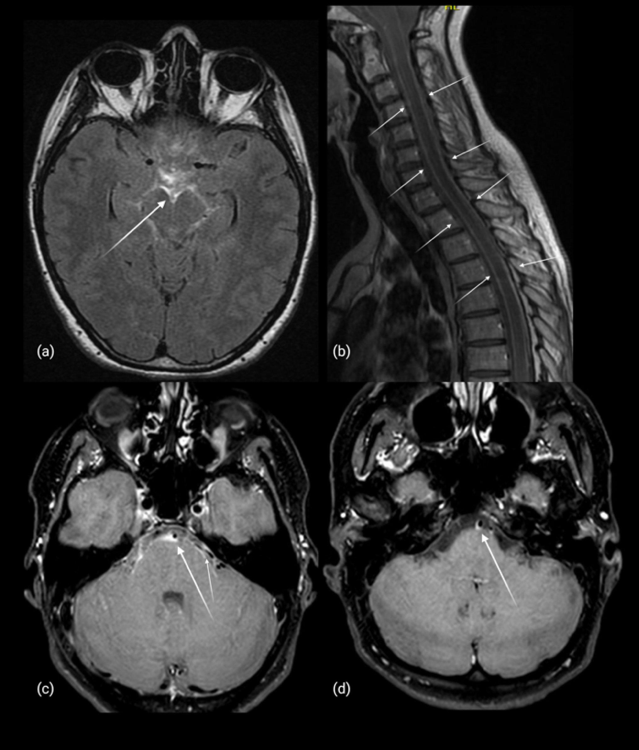 Ischemic stroke and transient ischemic attack associated with neuroborreliosis: a Danish retrospective cohort