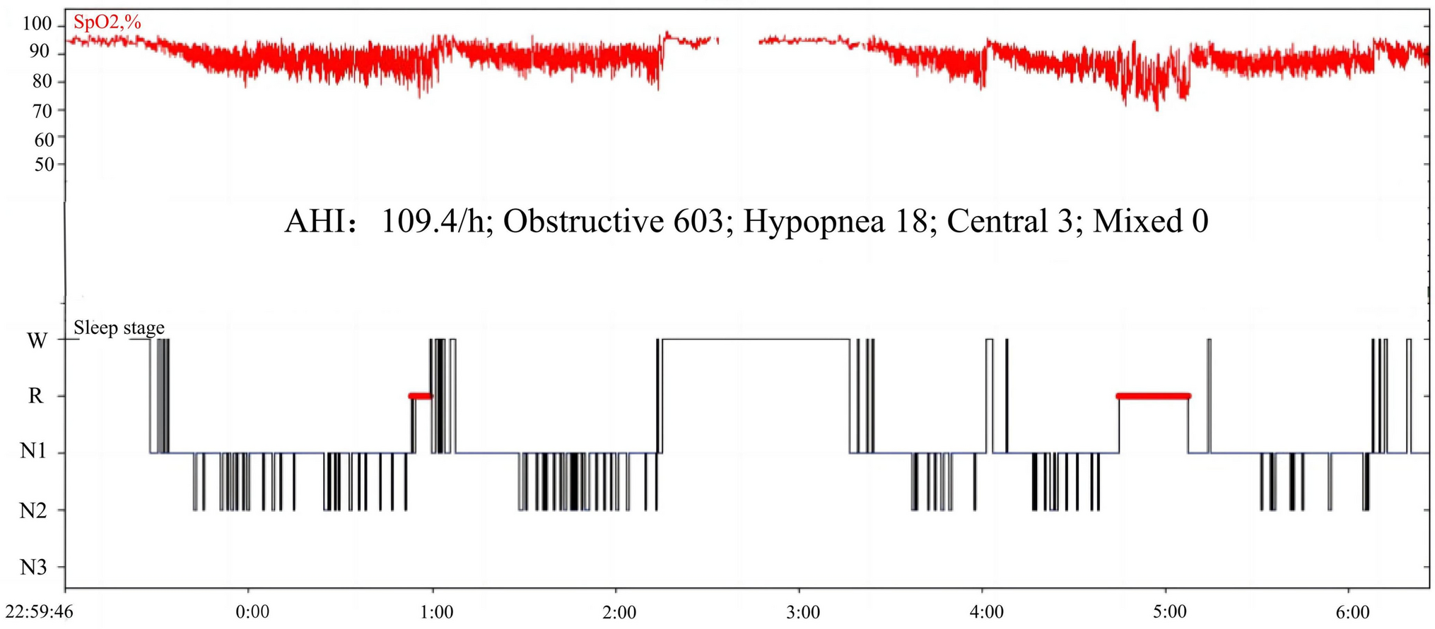 Recurrent nocturnal tongue biting mimicking epilepsy: a case report of severe obstructive sleep apnea