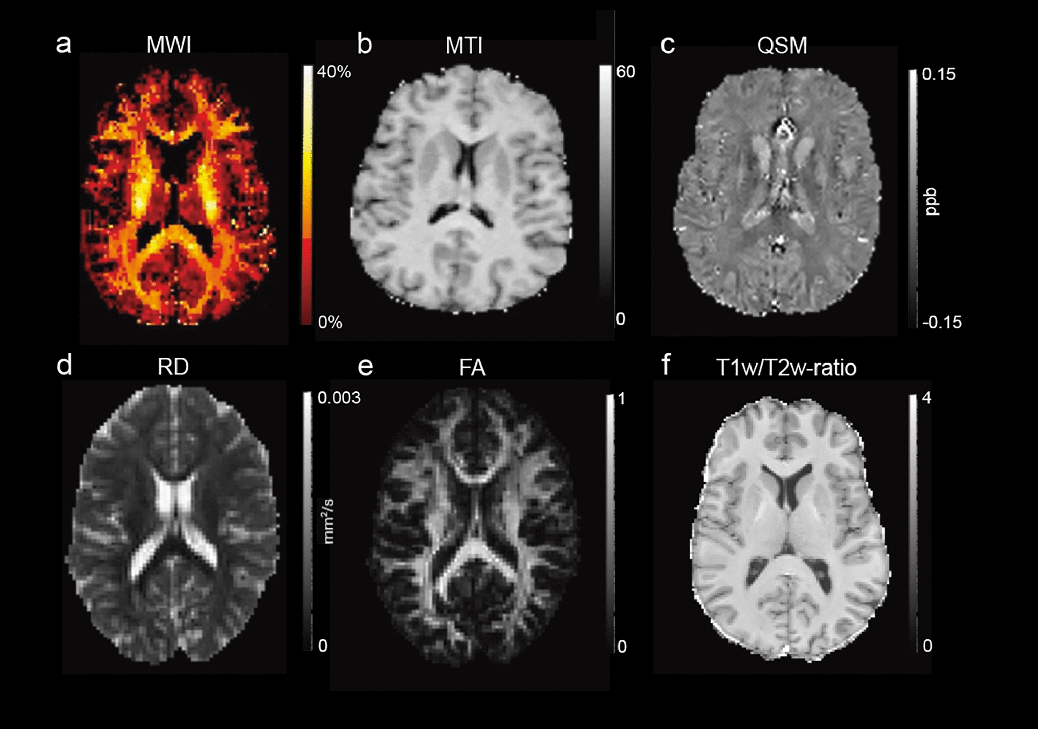 Longitudinal myelin MR imaging in patients with multiple sclerosis: a narrative review