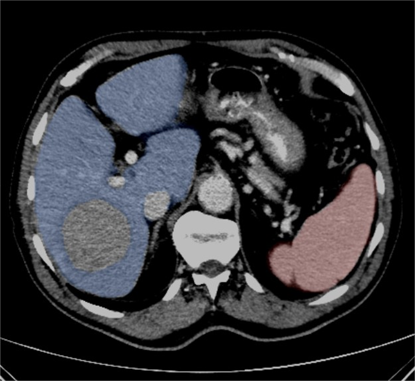 Fully automated spleen segmentation predicts progression-free survival in HCC patients following transarterial radioembolization