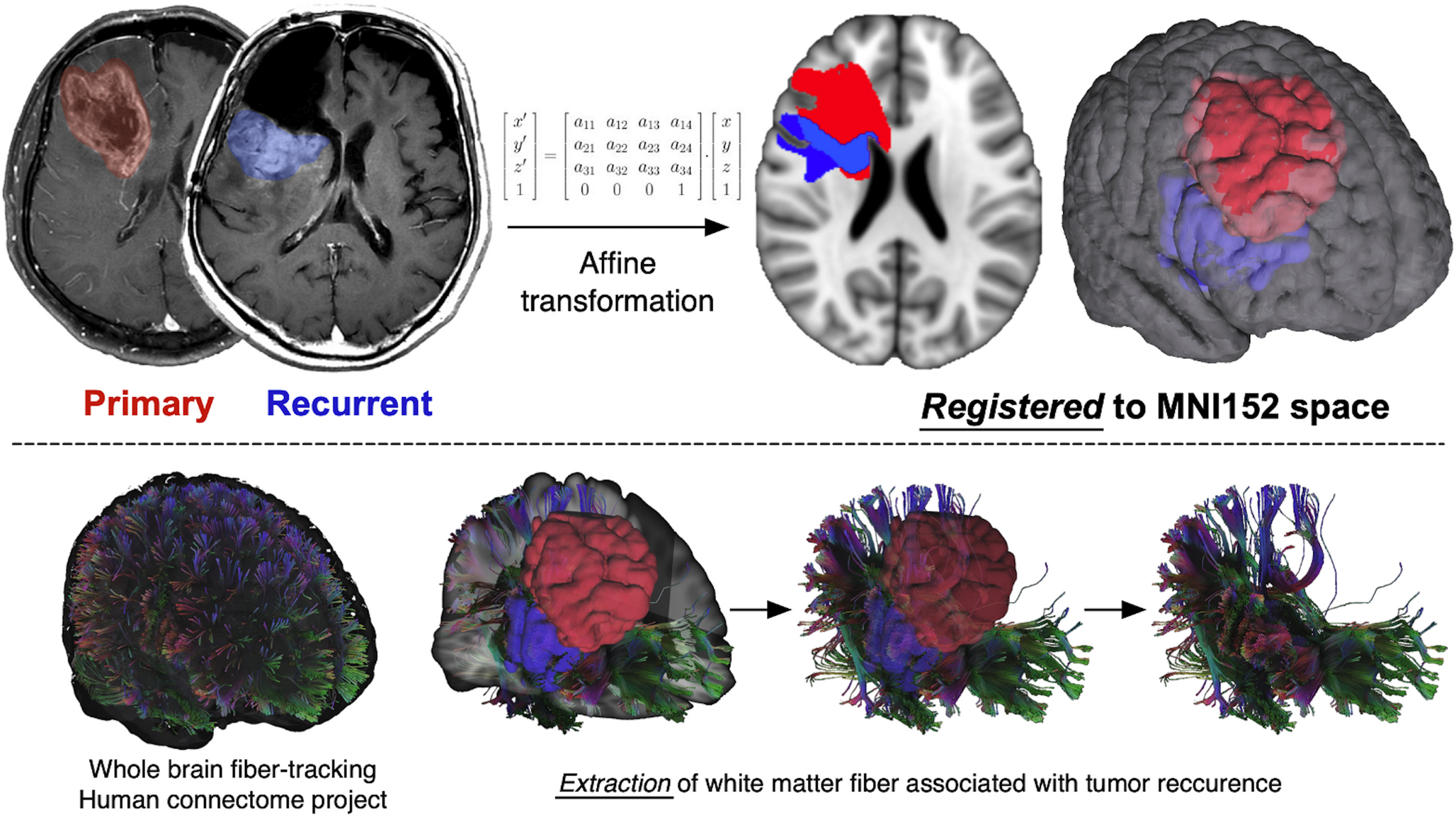 A voxel-based quantitative framework for analyzing the spatial redistribution and directionality of recurrence in glioblastoma