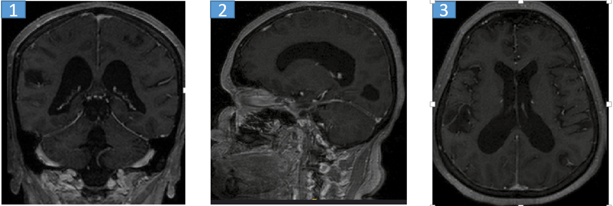Investigation of the effects of radiotherapy and chemotherapy on brain volume in cancer patients: brain tumor study