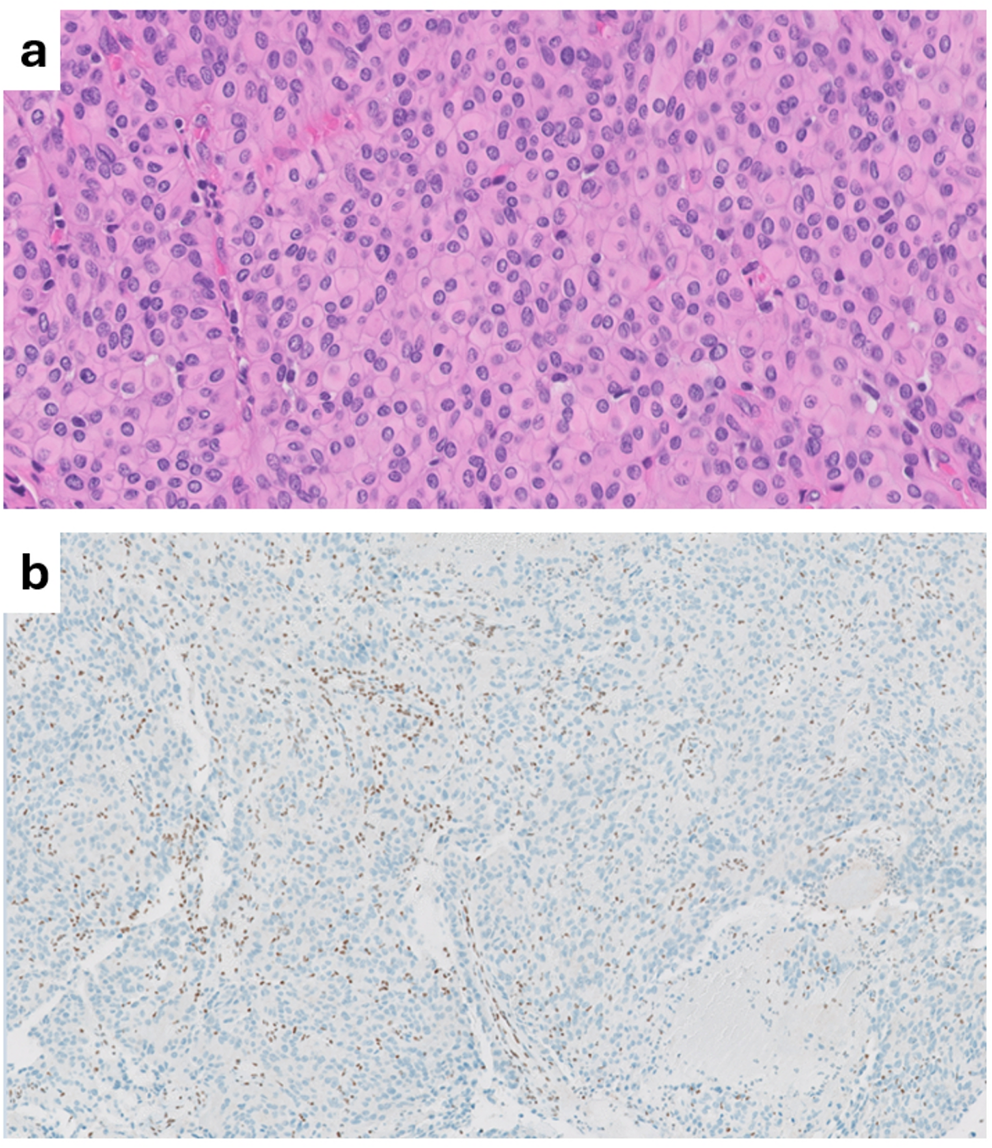 High frequency and unique subtypes of meningioma in patients with  tumor predisposition syndrome