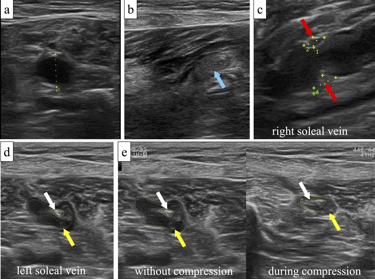 “Blowfish sign” of fresh and chronic mixed-vein thrombosis in the chronic phase after the 2024 Noto Peninsula earthquake
