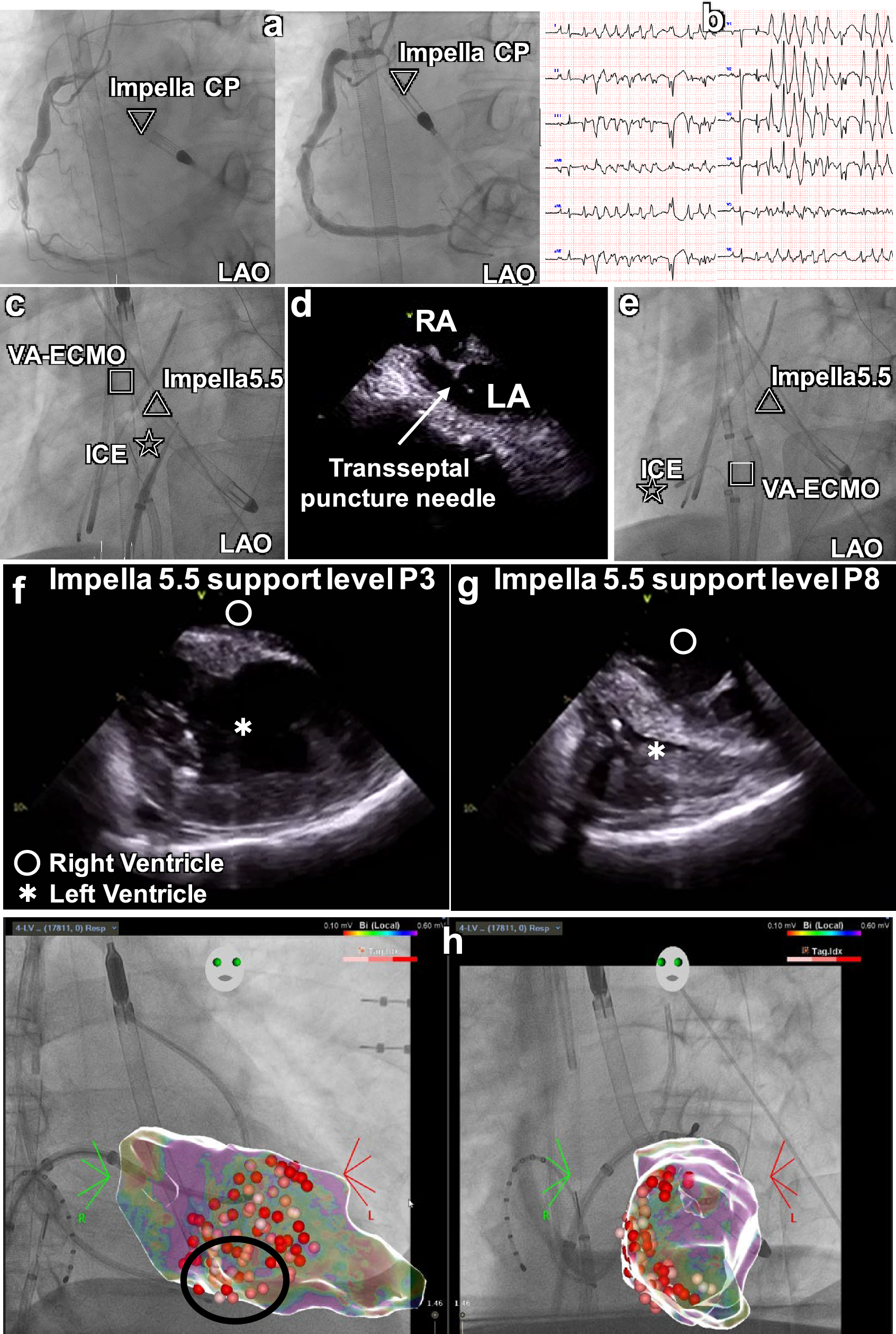 Optimizing Impella support level with intracardiac echocardiography during ventricular fibrillation storm ablation under veno-arterial extracorporeal membrane oxygenation