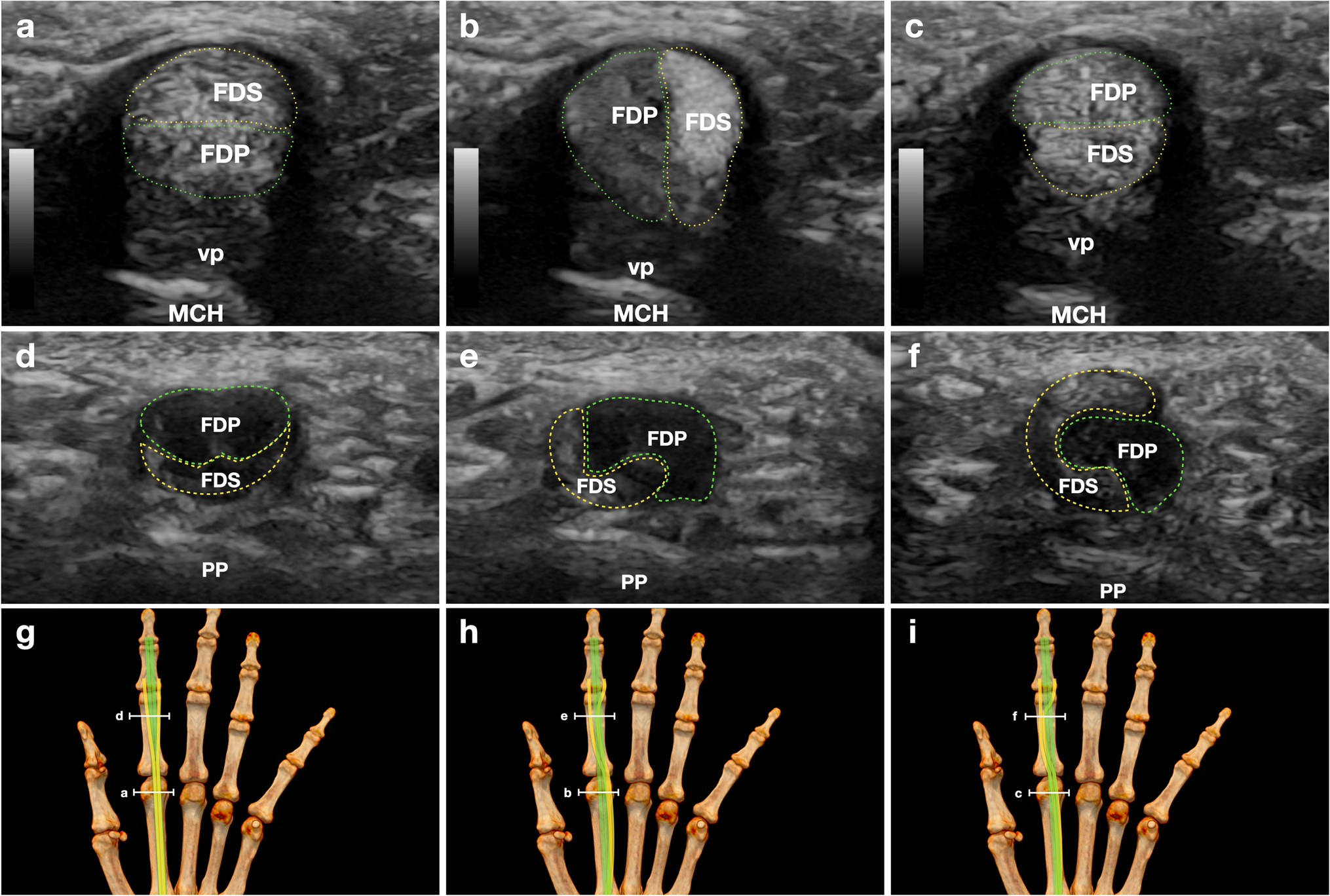 Intrasheath snapping of the flexor tendons of the index finger in a pediatric patient