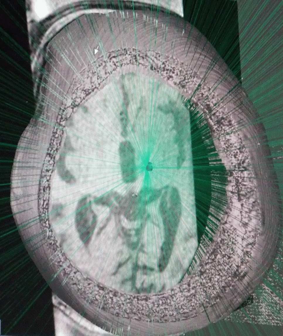 Focused ultrasound therapy for neurological disease