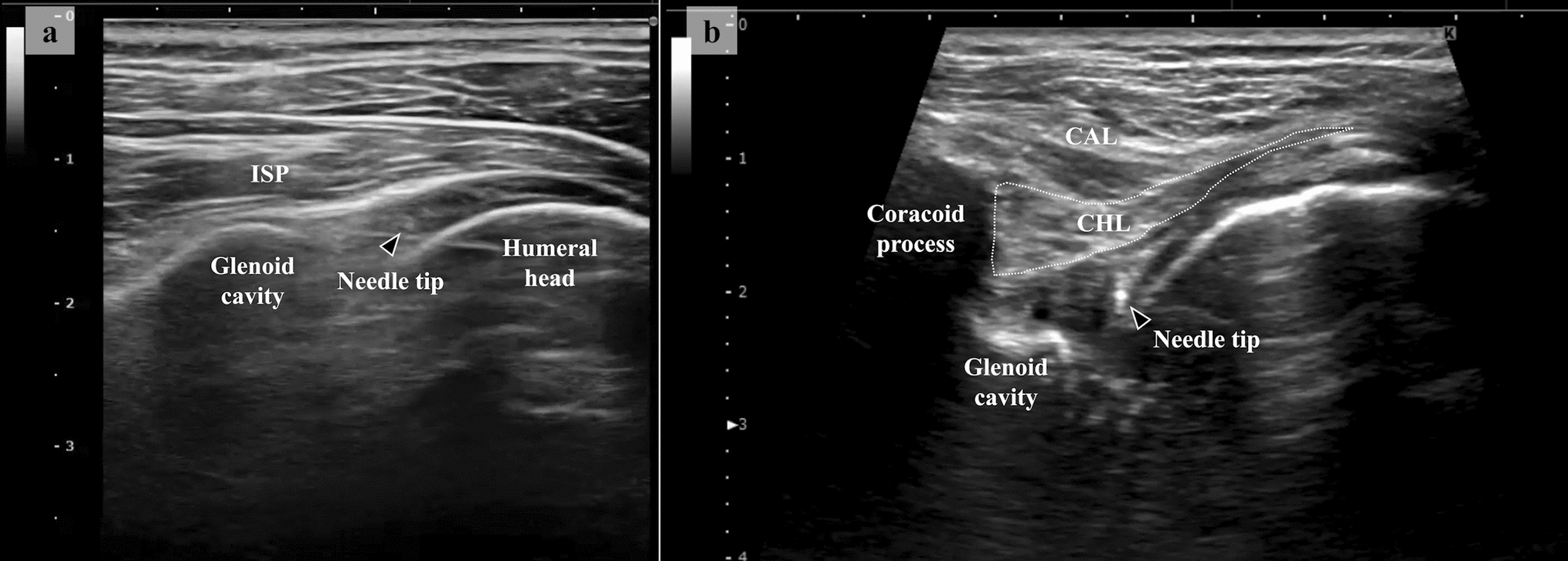 Enhanced manipulation technique for ultrasound-guided cervical nerve root block to improve shoulder external rotation in frozen shoulder: a retrospective study