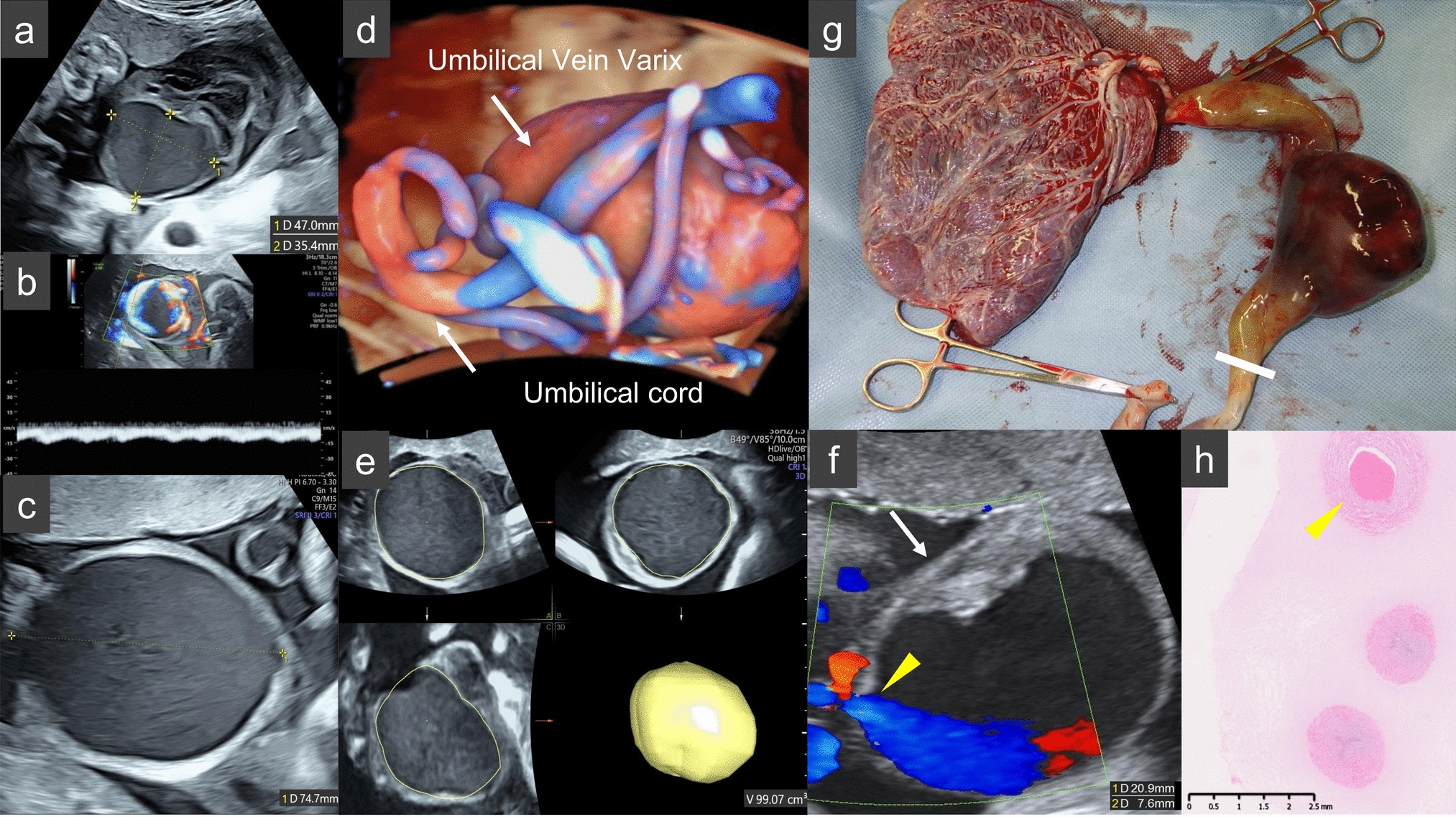 Prenatal detection of a thrombus within a giant extra-abdominal umbilical vein varix