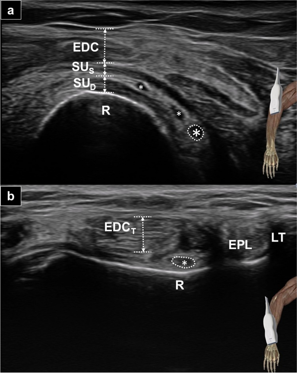 Short- vs. long-axis ultrasound-guided injections for the proximal and distal parts of the posterior interosseous nerve: a cadaveric study