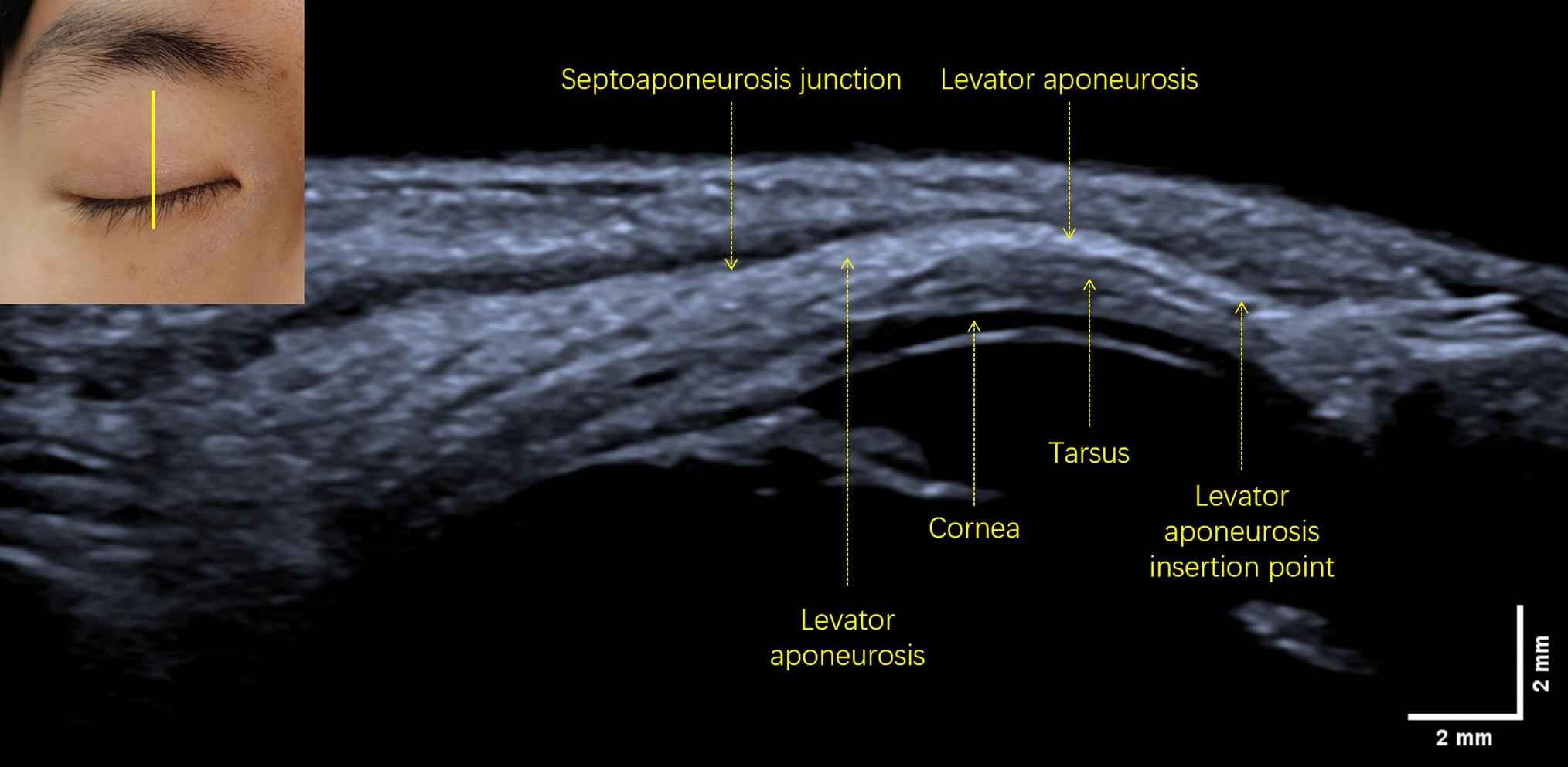 Measurement and analysis of the levator aponeurosis in unilateral aponeurotic ptosis using high-frequency (22 MHz) B-mode ultrasound with a water balloon