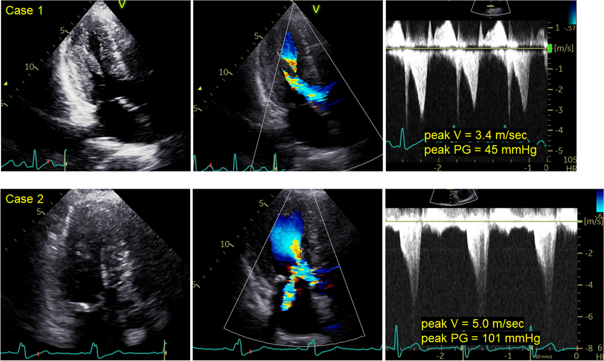 Suspecting obstructive hypertrophic cardiomyopathy
